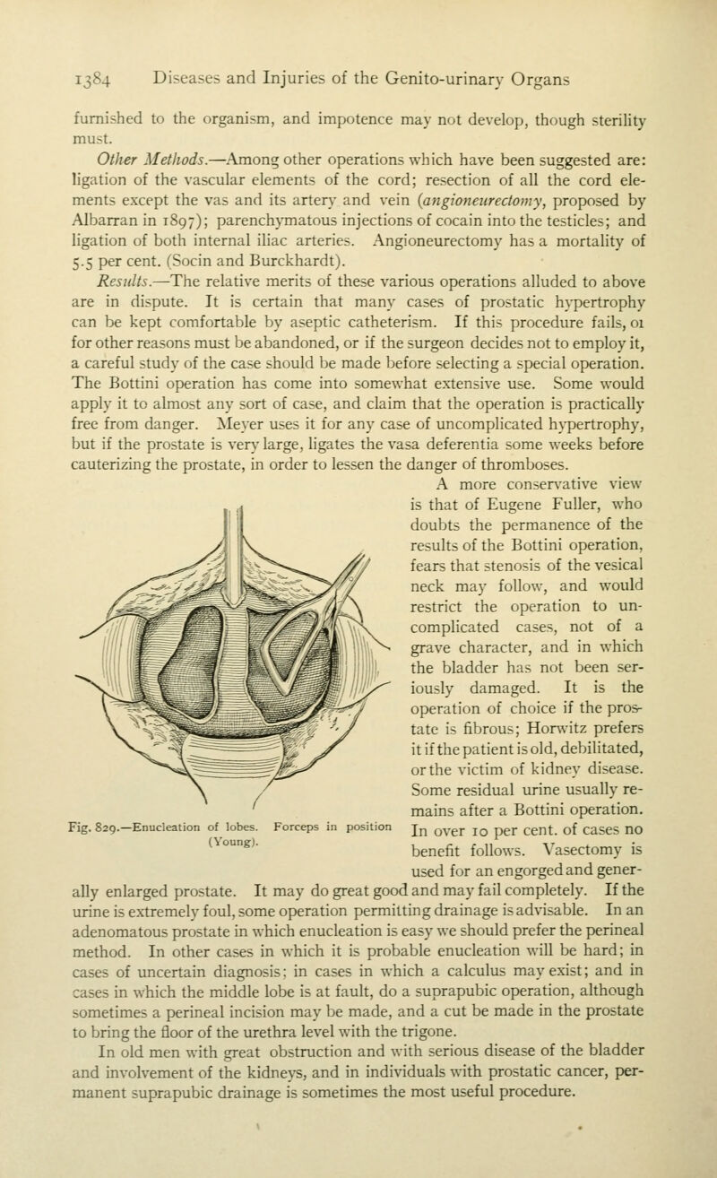 furnished to the organism, and impotence may not develofj, though steriHty must. Oiher Methods.—^Among other operations which have been suggested are: ligation of the vascular elements of the cord; resection of all the cord ele- ments except the vas and its arten' and vein (aftgioneureciomy, proposed by Albarran in 1897); parenchymatous injections of cocain into the testicles; and ligation of both internal iliac arteries. Angioneurectomy has a mortality of 5.5 per cent. (Socin and Burckhardt). Results.—The relative merits of these various operations alluded to above are in dispute. It is certain that many cases of prostatic hypertrophy can be kept comfortable by aseptic catheterism. If this procedure fails, oi for other reasons must be abandoned, or if the surgeon decides not to employ it, a careful study of the case should be made before selecting a special operation. The Bottini operation has come into somewhat extensive use. Some would apply it to almost any sort of case, and claim that the operation is practically free from danger. Meyer uses it for any case of uncomplicated hypertrophy, but if the prostate is very large, ligates the vasa deferentia some weeks before cauterizing the prostate, in order to lessen the danger of thromboses. A more consen'ative view is that of Eugene Fuller, who doubts the permanence of the results of the Bottini operation, fears that stenosis of the vesical neck may follow, and would restrict the operation to un- complicated cases, not of a grave character, and in which the bladder has not been ser- iously damaged. It is the operation of choice if the prosr tate is fibrous; Honvitz prefers it ifthe patient is old, debilitated, or the victim of kidney disease. Some residual urine usually re- mains after a Bottini operation. In over 10 per cent, of cases no benefit follows. Vasectomy is used for an engorged and gener- ally enlarged prostate. It may do great good and may fail completely. If the urine is extremely foul, some operation permitting drainage is advisable. In an adenomatous prostate in which enucleation is easy we should prefer the perineal method. In other cases in which it is probable enucleation will be hard; in cases of uncertain diagnosis: in cases in which a calculus may exist; and in cases in which the middle lobe is at fault, do a suprapubic operation, ahhough sometimes a perineal incision may be made, and a cut be made in the prostate to bring the floor of the urethra level with the trigone. In old men with great obstruction and with serious disease of the bladder and involvement of the kidneys, and in individuals with prostatic cancer, per- manent suprapubic drainage is sometimes the most useful procedure. Fig. 829.—Enucleation of lobes. (Voung). Forceps in position