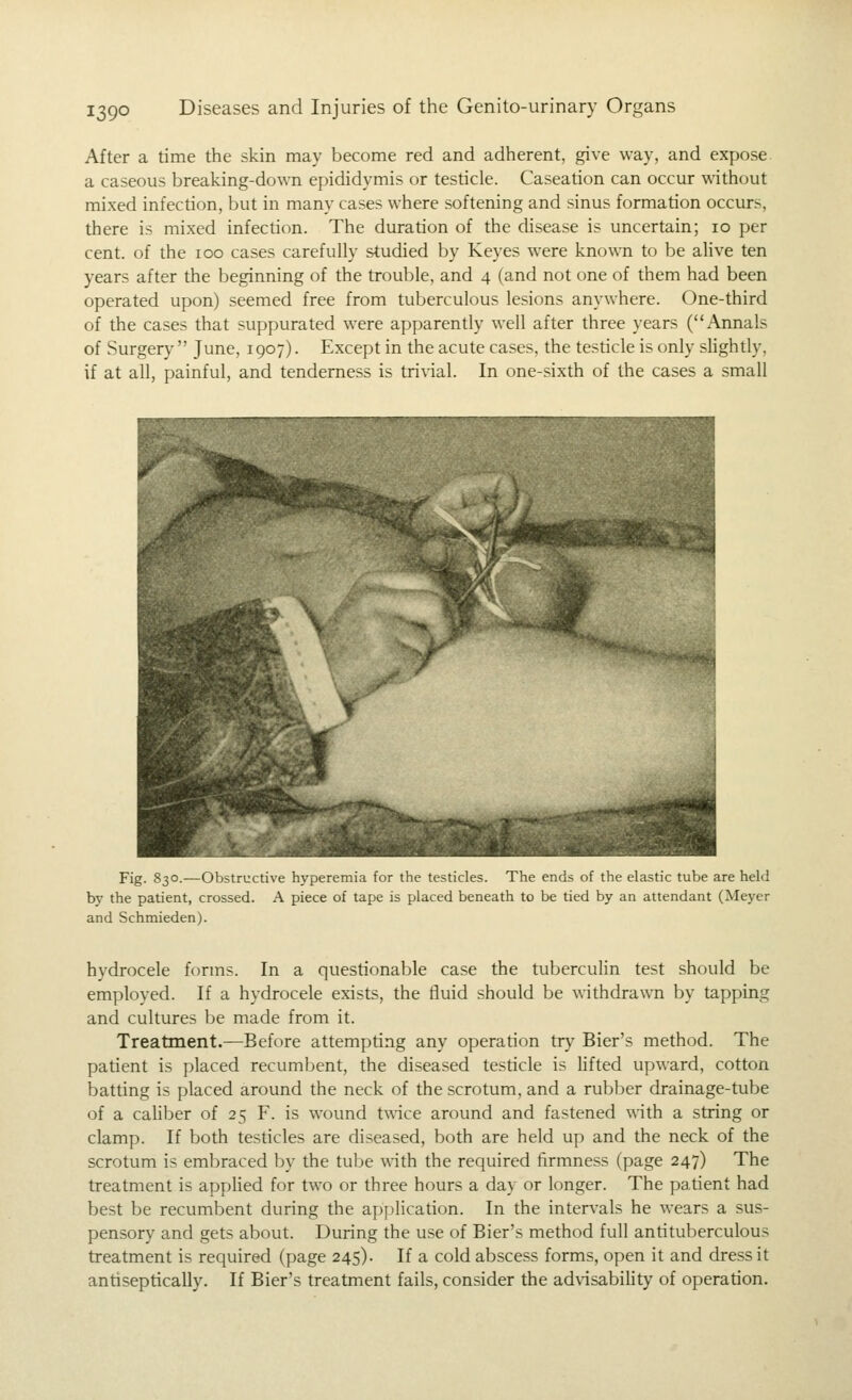 After a time the skin may become red and adherent, give way, and expose. a caseous breaking-down epididymis or testicle. Caseation can occur without mixed infection, but in many cases where softening and sinus formation occurs, there is mixed infection. The duration of the chsease is uncertain; 10 per cent, of the 100 cases carefully studied by Keyes were known to be alive ten years after the beginning of the trouble, and 4 (and not one of them had been operated upon) seemed free from tuberculous lesions anywhere. One-third of the cases that suppurated were apparendy well after three years (Annals of Surgery June, 1907). Except in the acute cases, the testicle is only sHghtly, if at all, painful, and tenderness is trivial. In one-sixth of the cases a small Fig. S30.—Obstructive hyperemia for the testicles. The ends of the elastic tube are held by the patient, crossed. A piece of tape is placed beneath to be tied by an attendant (Meyer and Schmieden). hydrocele forms. In a questionable case the tuberculin test should be employed. If a hydrocele exists, the fluid should be withdrawn by tapping and cultures be made from it. Treatment.—Before attempting any operation try Bier's method. The patient is placed recumbent, the diseased testicle is lifted upward, cotton batting is placed around the neck of the scrotum, and a rubber drainage-tube of a caHber of 25 F. is wound t\\'ice around and fastened with a string or clamp. If both testicles are diseased, both are held up and the neck of the scrotum is embraced by the tube \\ath the required firmness (page 247) The treatment is applied for two or three hours a day or longer. The patient had best be recumbent during the application. In the intervals he wears a sus- pensory and gets about. During the use of Bier's method full antituberculous treatment is required (page 245). If a cold abscess forms, open it and dress it antiseptically. If Bier's treatment fails, consider the addsability of operation.