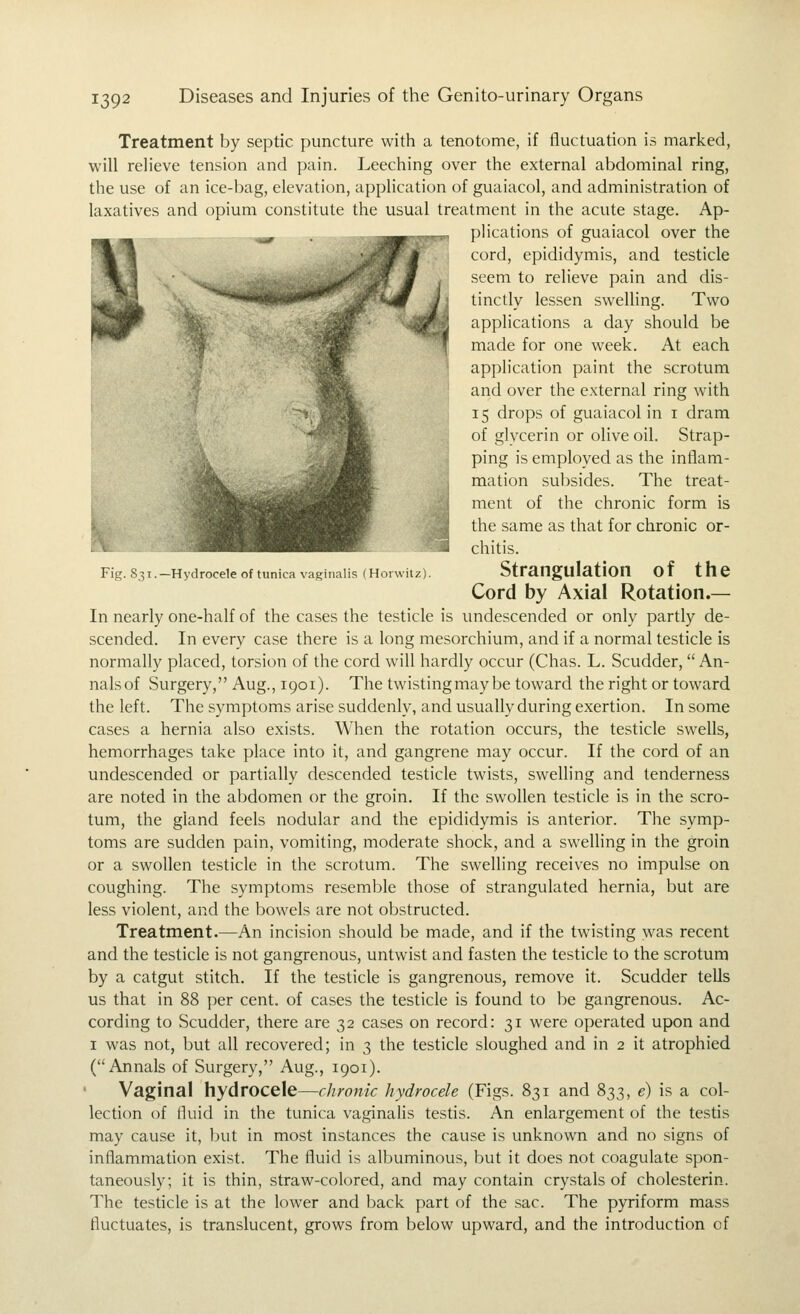Fig. 831.—Hydrocele of tunica vaginalis (Horwitz). Treatment by septic puncture with a tenotome, if fluctuation is marked, will relieve tension and pain. Leeching over the external abdominal ring, the use of an ice-bag, elevation, application of guaiacol, and administration of laxatives and opium constitute the usual treatment in the acute stage. Ap- plications of guaiacol over the cord, epididymis, and testicle seem to relieve pain and dis- tinctly lessen swelling. Two applications a day should be made for one week. At each application paint the scrotum and over the external ring with 15 drops of guaiacol in i dram of glycerin or olive oil. Strap- ping is employed as the inflam- mation subsides. The treat- ment of the chronic form is the same as that for chronic or- chitis. Strangulation of the Cord by Axial Rotation.— In nearly one-half of the cases the testicle is undescended or only partly de- scended. In every case there is a long mesorchium, and if a normal testicle is normally placed, torsion of the cord will hardly occur (Chas. L. Scudder,  An- nalsof Surgery, Aug., 1901). The twistingmay be toward the right or toward the left. The symptoms arise suddenly, and usually during exertion. In some cases a hernia also exists. When the rotation occurs, the testicle swells, hemorrhages take place into it, and gangrene may occur. If the cord of an undescended or partially descended testicle twists, swelling and tenderness are noted in the abdomen or the groin. If the swollen testicle is in the scro- tum, the gland feels nodular and the epididymis is anterior. The symp- toms are sudden pain, vomiting, moderate shock, and a swelling in the groin or a swollen testicle in the scrotum. The swelling receives no impulse on coughing. The symptoms resemble those of strangulated hernia, but are less violent, and the bowels are not obstructed. Treatment.—An incision should be made, and if the twisting was recent and the testicle is not gangrenous, untwist and fasten the testicle to the scrotum by a catgut stitch. If the testicle is gangrenous, remove it. Scudder tells us that in 88 per cent, of cases the testicle is found to be gangrenous. Ac- cording to Scudder, there are 32 cases on record: 31 were operated upon and I was not, but all recovered; in 3 the testicle sloughed and in 2 it atrophied (Annals of Surgery, Aug., 1901). Vaginal hydrocele—chronic hydrocele (Figs. 831 and 833, e) is a col- lection of fluid in the tunica vaginalis testis. An enlargement of the testis may cause it, but in most instances the cause is unknown and no signs of inflammation exist. The fluid is albuminous, but it does not coagulate spon- taneously; it is thin, straw-cok)red, and may contain crystals of cholesterin. The testicle is at the lower and back part of the sac. The pyriform mass fluctuates, is translucent, grows from below upward, and the introduction of