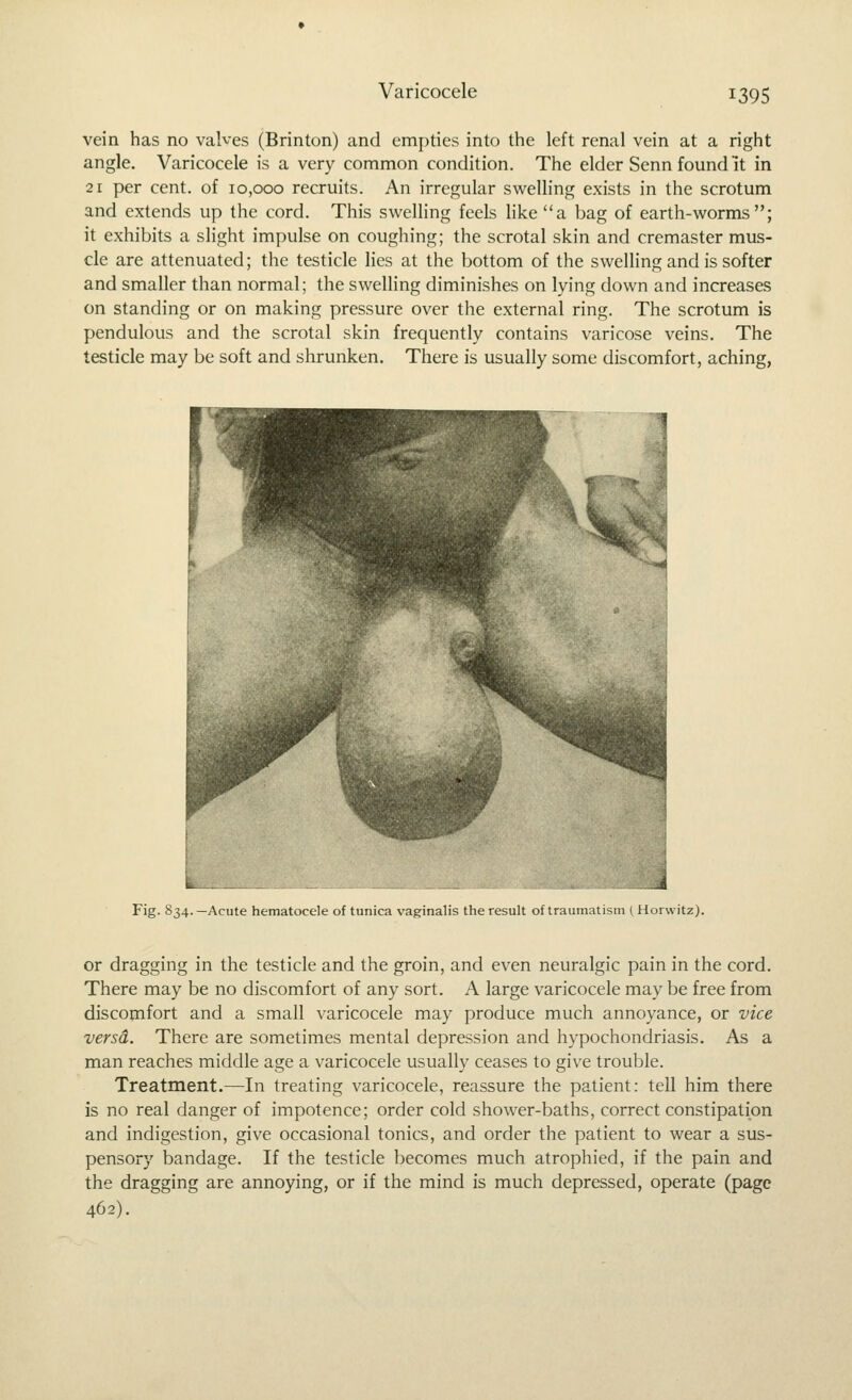 Varicocele vein has no vaWes (Brinton) and empties into the left renal vein at a right angle. Varicocele is a very common condition. The elder Senn found it in 21 per cent, of 10,000 recruits. An irregular sv^^elling exists in the scrotum and extends up the cord. This swelling feels like a bag of earth-worms; it exhibits a slight impulse on coughing; the scrotal skin and cremaster mus- cle are attenuated; the testicle lies at the bottom of the swelling and is softer and smaller than normal; the swelling diminishes on lying down and increases on standing or on making pressure over the external ring. The scrotum is pendulous and the scrotal skin frequently contains varicose veins. The testicle may be soft and shrunken. There is usually some discomfort, aching, Fig. 834.—Acute hematocele of tunica vaginalis the result of traumatism ( iiurwitz). or dragging in the testicle and the groin, and even neuralgic pain in the cord. There may be no discomfort of any sort. A large varicocele may be free from discomfort and a small varicocele may produce much annoyance, or vice versd. There are sometimes mental depression and hypochondriasis. As a man reaches middle age a varicocele usually ceases to give trouble. Treatment.—In treating varicocele, reassure the patient: tell him there is no real danger of impotence; order cold shower-baths, correct constipation and indigestion, give occasional tonics, and order the patient to wear a sus- pensory bandage. If the testicle becomes much atrophied, if the pain and the dragging are annoying, or if the mind is much depressed, operate (page 462).
