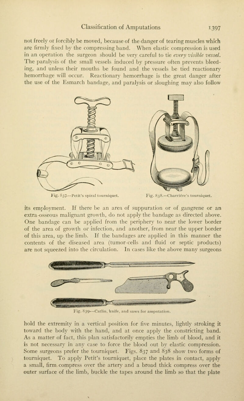 not freely or forcibly be moved, because of the danger of tearing muscles which are firmly fixed by the com[)re.ssing band. When elastic compression is used in an operation the surgeon should be very careful to tie every visible vessel. The paralysis of the small vessels induced by pressure often prevents bleed- ing, and unless their mouths be found and the vessels be tied reactionary^ hemorrhage will occur. Reactionary hemorrhage is the great danger after the use of the Esmarch bandage, and paralysis or sloughing may also follow Fig. S37.—Petit's spiral tourniquet. Fig. 838.—Charriere's tourniquet. its employment. If there be an area of suppuration or of gangrene or an extra-osseous malignant growth, do not apply the bandage as directed above. One bandage can be applied from the periphery to near the lower border of the area of growth or infection, and another, from near the upper border of this area, up the h'mb. If the bandages are applied in this manner the contents of the diseased area (tumor-cells and fluid or septic products) are not squeezed into the circulation. In cases like the above many surgeons Fig- 839—Catliu. knife, and saws for amputation. hold the extremity in a vertical position for five minutes, lightly stroking it toward the body with the hand, and at once apply the constricting band. As a matter of fact, this plan satisfactorily empties the hmb of blood, and it is not necessary in any case to force the blood out by elastic compression. Some surgeons prefer the tourniquet. Figs. 837 and 838 show two forms of tourniquet. To apply Petit's tourniquet, place the plates in contact, apply a small, firm compress over the artery and a broad thick compress over the outer surface of the limb, buckle the tapes around the hmb so that the plate