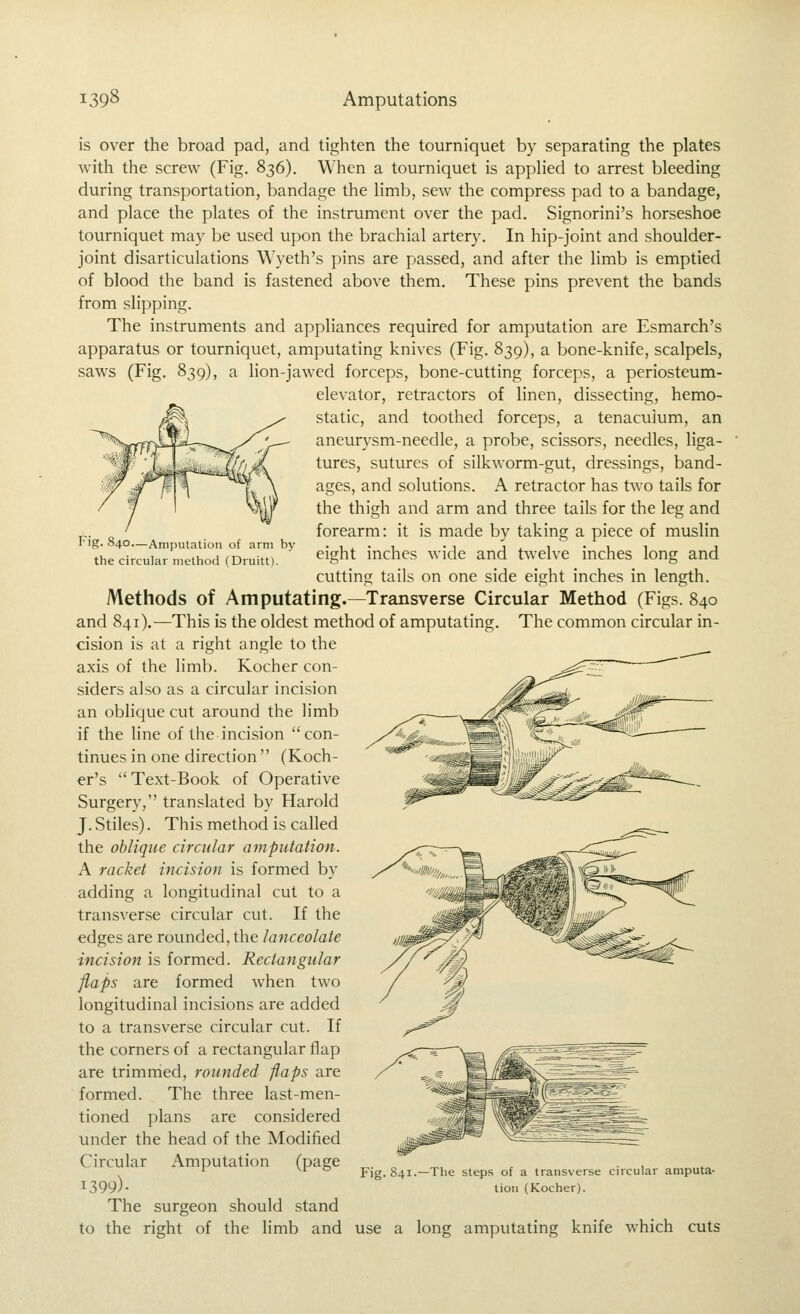 Fig. 840—Amputation of arm by the circular method (Druitt). is over the broad pad, and tighten the tourniquet by separating the plates with the screw (Fig. 836). When a tourniquet is applied to arrest bleeding during transportation, bandage the limb, sew the compress pad to a bandage, and place the plates of the instrument over the pad. Signorini's horseshoe tourniquet may be used upon the brachial artery. In hip-joint and shoulder- joint disarticulations Wyeth's pins are passed, and after the limb is emptied of blood the band is fastened above them. These pins prevent the bands from slipping. The instruments and appliances required for amputation are Esmarch's apparatus or tourniquet, amputating knives (Fig. 839), a bone-knife, scalpels, saws (Fig. 839), a lion-jawed forceps, bone-cutting forceps, a periosteum- elevator, retractors of linen, dissecting, hemo- static, and toothed forceps, a tenaculum, an aneurysm-needle, a probe, scissors, needles, liga- tures, sutures of silkworm-gut, dressings, band- ages, and solutions. A retractor has two tails for the thigh and arm and three tails for the leg and forearm: it is made by taking a piece of muslin eight inches wide and twelve inches long and cutting tails on one side eight inches in length. Methods of Amputating.—Transverse Circular Method (Figs. 840 and 841).^—This is the oldest method of amputating. The common circular in- cision is at a right angle to the axis of the limb. Kocher con- siders also as a circular incision an oblique cut around the limb if the line of the incision con- tinues in one direction'' (Koch- er's Text-Book of Operative Surgery, translated by Harold J. Stiles). This method is called the oblique circular amputation. A racket incision is formed by adding a longitudinal cut to a transverse circular cut. If the edges are rounded, the lanceolate incision is formed. Rectangular flaps are formed when two longitudinal incisions are added to a transverse circular cut. If the corners of a rectangular flap are trimmed, rounded flaps are formed. The three last-men- tioned plans are considered under the head of the Modified Circular Amputation (page 1399)- The surgeon should stand to the right of the limb and use a long amputating knife which cuts Fig. 841.—The steps of a transverse circular amputa- tion (Kocher).