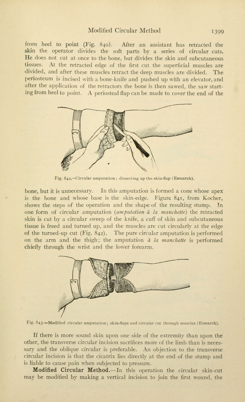 Modified Circular Method from heel to point (Fig. 840). After an assistant has retracted the skin the operator divides the soft parts by a series of circular cuts. He does not cut at once to the bone, but divides the skin and subcutaneous tissues. At the retracted edge of the first cut the superficial muscles are divided, and after these muscles retract the deep muscles are divided. The periosteum is incised with a bone-knife and pushed up with an elevator, and after the application of the retractors the bone is then sawed, the saw start- ing from heel to point. A periosteal flap can be made to cover the end of the Fig. 842.—Circular amputation ; dissecting up the skin-flap (Esmarch). bone, but it is unnecessary. In this amputation is formed a cone whose apex is the bone and whose base is the skin-edge. Figure 841, from Kocher, shows the steps of the operation and the shape of the resulting stump. In one form of circular amputation {amputation a la manchette) the retracted skin is cut by a circular sweep of the knife, a cuff of skin and subcutaneous tissue is freed and turned up, and the muscles are cut circularly at the edge of the turned-up cut (Fig. 842). The pure circular amputation is performed on the arm and the thigh; the amputation a la manchette is performed chiefly through the wrist and the lower forearm. Fig-843.—Modified circular amputation ; skin-flaps and circular cut through muscles (Esmarch). If there is more sound skin upon one side of the extremity than upon the other, the transverse circular incision sacrifices more of the hmb than is neces- sary and the oblique circular is preferable. An objection to the transverse circular incision is that the cicatrix hes directly at the end of the stump and is liable to cause pain when subjected to pressure. Modified Circular Method.—In this operation the circular skin-cut may be modified by making a vertical incision to join the first wound, the