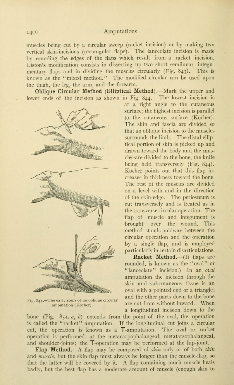 muscles being cut by a circular sweep (racket incision) or by making two vertical skin-incisions (rectangular flaps). The lanceolate incision is made by rounding the edges of the flaps which result from a racket incision. Liston's modification consists in dissecting up two short semilunar integu- mentary flaps and in dividing the muscles circularly (Fig. 843). This is known as the mixed method. The modified circular can be used upon the thigh, the leg, the arm, and the forearm. Oblique Circular Method (Elliptical Method).—Mark the upper and lower ends of the incision as shown in Fig. 844. The lowest incision is at a right angle to the cutaneous surface; the highest incision is parallel to the cutaneous surface (Kocher). The skin and fascia are divided so that an oblique incision to the muscles surrounds the limb. The distal ellip- tical portion of skin is picked up and drawn toward the body and the mus- cles'are divided to the bone, the knife being held transversely (Fig. 844). Kocher points out that this flap in- creases in thickness toward the bone. The rest of the muscles are divided on a level with and in the direction of the skin-edge. The periosteum is cut transversely and is treated as in the transverse circular operation. The flap of muscle and integument is brought over the wound. This method stands midway between the circular operation and the operation by a single flap, and is employed particularly in certain disarticulations. Racket Method.—(If flaps are rounded, is known as the oval or lanceolate incision.) In an oval amputation the incision through the skin and subcutaneous tissue is an oval with a pointed end or a triangle; and the other parts down to the bone are cut from without inward. WTien a longitudinal incision down to the bone (Fig. 854, a, h) extends from the point of the oval, the operation is called the racket amputation. If the longitudinal cut joins a circular cut, the operation is known as a T-amputation. The oval or racket operation is performed at the metacarpophalangeal, metatarsophalangeal, and shoulder-joints; the T-operation may be performed at the hip-joint. Flap Method.—A flap may be composed of 5^/;? only or of both skin and muscle, but the skin-flap must always be longer than the muscle-flap, so that the latter will be covered by it. A flap containing much muscle heals badly, but the best flap has a moderate amount of muscle (enough skin to Fig. 844.—The early steps of an oblique circular amputation (Kocher).