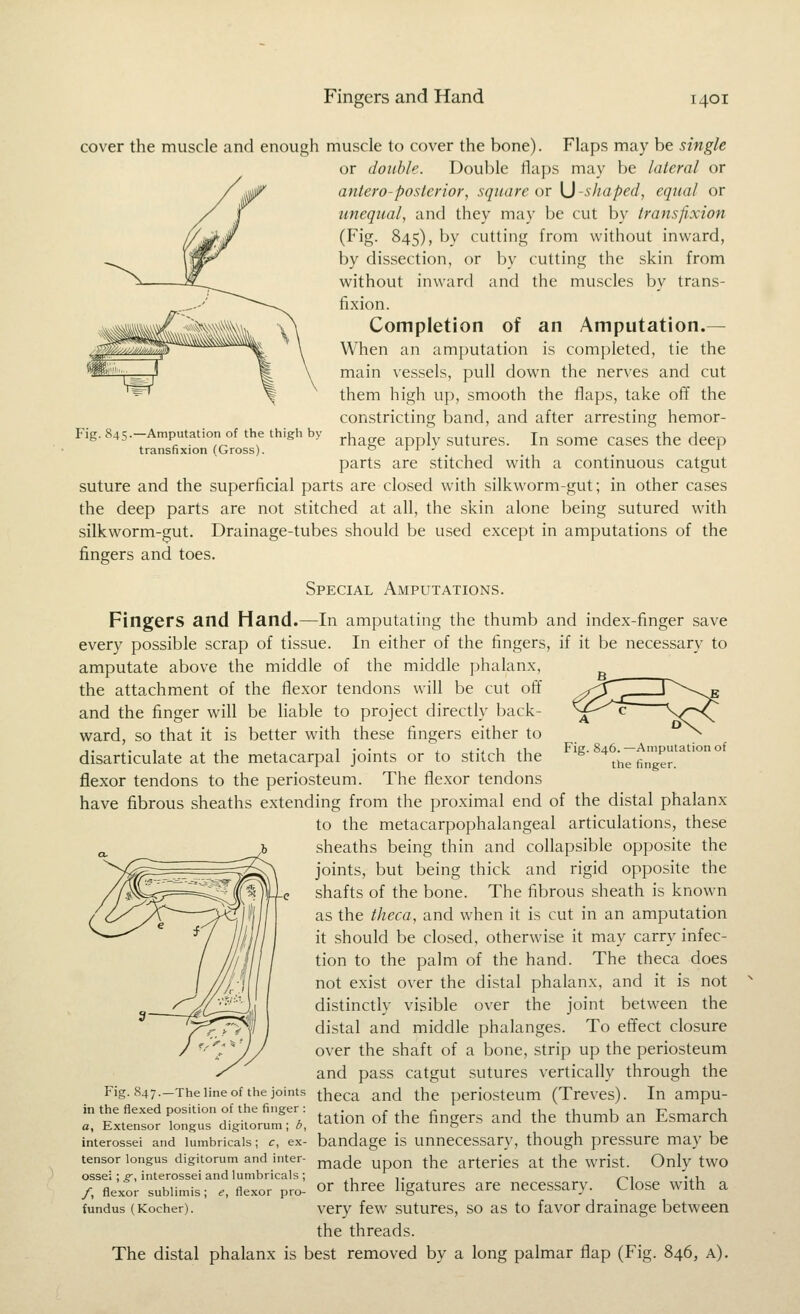 Fig. 845.—Amputation of the thigh by transfixion (Gross). cover the muscle and enough muscle to cover the bone). Flaps may be single or double. Double flaps may be lateral or antero-posterior, square or \j-shaped, equal or unequal, and they may be cut by transfixion (Fig. 845), by cutting from without inward, by dissection, or by cutting the skin from without inward and the muscles by trans- fixion. Completion of an Amputation.— When an amputation is completed, tie the main vessels, pull down the nerves and cut them high up, smooth the flaps, take off the constricting band, and after arresting hemor- rhage apply sutures. In some cases the deep parts are stitched with a continuous catgut suture and the superficial parts are closed with silkworm-gut; in other cases the deep parts are not stitched at all, the skin alone being sutured with silkworm-gut. Drainage-tubes should be used except in amputations of the fingers and toes. Special Amputations. Fingers and Hand.—In amputating the thumb and index-finger save every possible scrap of tissue. In either of the fingers, if it be necessary to amputate above the middle of the middle phalanx, ^ the attachment of the flexor tendons will be cut off and the finger will be liable to project directly back- ward, so that it is better with these fingers either to disarticulate at the metacarpal joints or to stitch the flexor tendons to the periosteum. The flexor tendons have fibrous sheaths extending from the proximal end of the distal phalanx to the metacarpophalangeal articulations, these sheaths being thin and collapsible opposite the joints, but being thick and rigid opposite the shafts of the bone. The fibrous sheath is known as the theca, and when it is cut in an amputation it should be closed, otherwise it may carry infec- tion to the palm of the hand. The theca does not exist over the distal phalanx, and it is not distinctly visible over the joint between the distal and middle phalanges. To effect closure over the shaft of a bone, strip up the periosteum and pass catgut sutures vertically through the Fig. 847.-The line of the joints theca and the periosteum (Treves). In ampu- in the flexed position of the finger: ^^ ^^^^^ ^^ Esmarch a, Extensor longus digitorum ; b, '•''  & interossei and lumbricais; c, ex- bandage is unnecessary, though pressure may be tensor longus digitorum and inter- ^lade upon the arteries at the wrist. Only two ossei : p-, interossei and lumbricais; , t . /^i '^i /, flexor subiimis; e, flexor pro- or three ligatures are necessary. Close with a fundus (Kocher). very few sutures, so as to favor drainage between the threads. The distal phalanx is best removed by a long palmar flap (Fig. 846, a). Fig. 846. —Amputation of the finger.