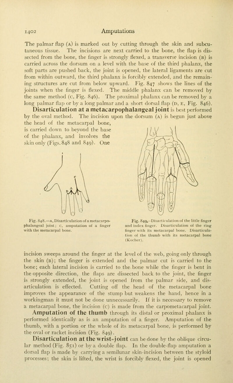 The palmar flap (a) is marked out by cutting through the slcin and subcu- taneous tissue. The incisions are next carried to the bone, the flap is dis- sected from the bone, the finger is strongly flexed, a transverse incision (b) is carried across the dorsum on a level with the base of the third phalanx, the soft parts are pushed back, the joint is opened, the lateral ligaments are cut from within outward, the third phalanx is forcibly extended, and the remain- ing structures are cut from below upward. Fig. 847 shows the lines of the joints when the finger is flexed. The middle phalanx can be removed by the same method (c, Fig. 846). The proximal phalanx can be removed by a long palmar flap or by a long palmar and a short dorsal flap (d, e. Fig. 846). Disarticulation at a metacarpophalangeal joint is best performed by the oval method. The incision upon the dorsum (a) is begun just above the head of the metacarpal bone, is carried down to beyond the base of the phalanx, and involves the skin only (Figs. 848 and 849). One Fig. 848.—A, Disarticulation of a metacarpo- phalangeal joint; c, amputation of a finger with the metacarpal bone. Fig. 849.—Disarticulation of the little finger and index finger. Disarticulation of the ring finger with its metacarpal bone. Disarticula- tion of the thumb with its metacarpal bone (Kocher). incision sweeps around the finger at the level of the web, going only through the skin (b) ; the finger is e.xtended and the palmar cut is carried to the bone; each lateral incision is carried to the bone while the finger is bent in the opposite direction, the flaps are dissected back to the joint, the finger is strongly extended, the joint is opened from the palmar side, and dis- articulation is effected. Cutting off the head of the metacarpal bone improves the appearance of the stump but weakens the hand, hence in a workingman it must not be done unnecessarily. If it is necessary to remove a metacarpal bone, the incision (c) is made from the carpometacarpal joint. Amputation of the thumb through its distal or proximal phalanx is performed identically as is an amputation of a finger. Amputation of the thumb, with a portion or the whole of its metacarpal bone, is performed by the oval or racket incision (Fig. 849). Disarticulation atthewrist=joint can be done by the obhque circu- lar method (Fig. 851) or by a double flap. In the double-flap amputation a dorsal flap is made by carrying a semilunar skin-incision between the styloid processes; the skin is lifted, the wrist is forcibly flexed, the joint is opened