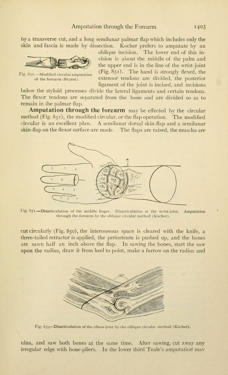 Fig. 850—Modified circular amputation of the forearm (Bryant). by a transverse cut, and a long semilunar palmar flap which includes only the skin and fascia is made by dissection. Kocher prefers to amputate by an oblique incision. The lower end of this in- cision is about the middle of the palm and the upper end is in the line of the wrist-joint (Fig. 851). The hand is strongly flexed, the extensor tendons are divided, the posterior ligament of the joint is incised, and incisions below the styloid processes divide the lateral ligaments and certain tendons. The flexor tendons are separated from the bone and are divided so as to remain in the palmar flap. Amputation through the forearm may be effected by the circular method (Fig. 851), the modified circular, or the flap operation. The modified circular is an excellent plan. A semilunar dorsal skin-flap and a semilunar skin-flap on the flexor surface are made. The flaps are raised, the muscles are I''g-851.—Disarticulation of the middle finger. Disarticulation at the wrist-joint. Amputation through the forearm by the oblique circular method (Kocher). cut circularly (Fig. 850), the interosseous space is cleared with the knife, a three-tailed retractor is applied, the periosteum is pushed up, and the bones are sawn half an inch above the flap. In sawing the bones, start the saw upon the radius, draw it from heel to point, make a furrow on the radius and Fig. 852.—Disarticulation of the elbow-joint by the oblique circular method (Kocher). ulna, and saw both bones at the same time. After sawing, cut away any irregular edge with bone-pliers. In the lower third Teale's amputatiorf mav