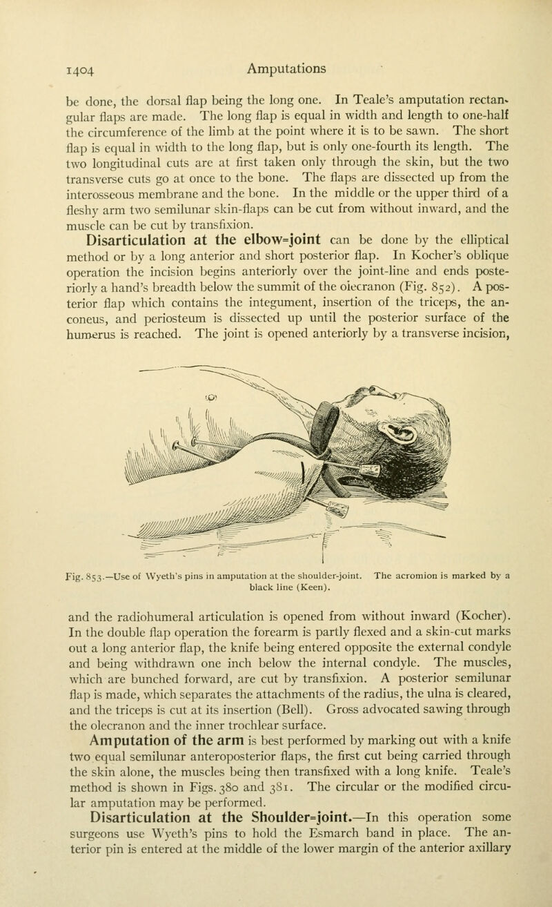 be done, the dorsal flap being the long one. In Teale's amputation rectan- gular flaps are made. The long flap is equal in width and length to one-half the circumference of the limb at the point where it is to be sawn. The short flap is equal in width to the long flap, but is only one-fourth its length. The two longitudinal cuts are at first taken only through the skin, but the two transverse cuts go at once to the bone. The flaps are dissected up from the interosseous membrane and the bone. In the middle or the upper third of a fleshy arm two semilunar skin-flaps can be cut from without inward, and the muscle can be cut by transfixion. Disarticulation at the elbow=joint can be done by the elHptical method or by a long anterior and short posterior flap. In Kocher's oblique operation the incision begins anteriorly over the joint-line and ends poste- riorly a hand's breadth below the summit of the olecranon (Fig. 852). A pos- terior flap which contains the integument, insertion of the triceps, the an- coneus, and periosteum is dissected up until the posterior surface of the humerus is reached. The joint is opened anteriorly by a transverse incision, Fig. 853.—Use of Wyeth's pins in amputation at the shoulder-joint. The acromion is marked by a black line (Keen). and the radiohumeral articulation is opened from without inward (Kocher). In the double flap operation the forearm is partly flexed and a skin-cut marks out a long anterior flap, the knife being entered opposite the external condyle and being withdrawn one inch below the internal condyle. The muscles, which are bunched forward, are cut by transfixion. A posterior semilunar flap is made, which separates the attachments of the radius, the ulna is cleared, and the triceps is cut at its insertion (Bell). Gross advocated sawing through the olecranon and the inner trochlear surface. Amputation of the arm is best performed by marking out with a knife two equal semilunar anteroposterior flaps, the first cut being carried through the skin alone, the muscles being then transfixed with a long knife. Teale's method is shown in Figs. 380 and 381. The circular or the modified circu- lar amputation may be performed. Disarticulation at the Shoulder=joint.—In this operation some surgeons use Wyeth's pins to hold the Esmarch band in place. The an- terior pin is entered at the middle of the lower margin of the anterior axillary