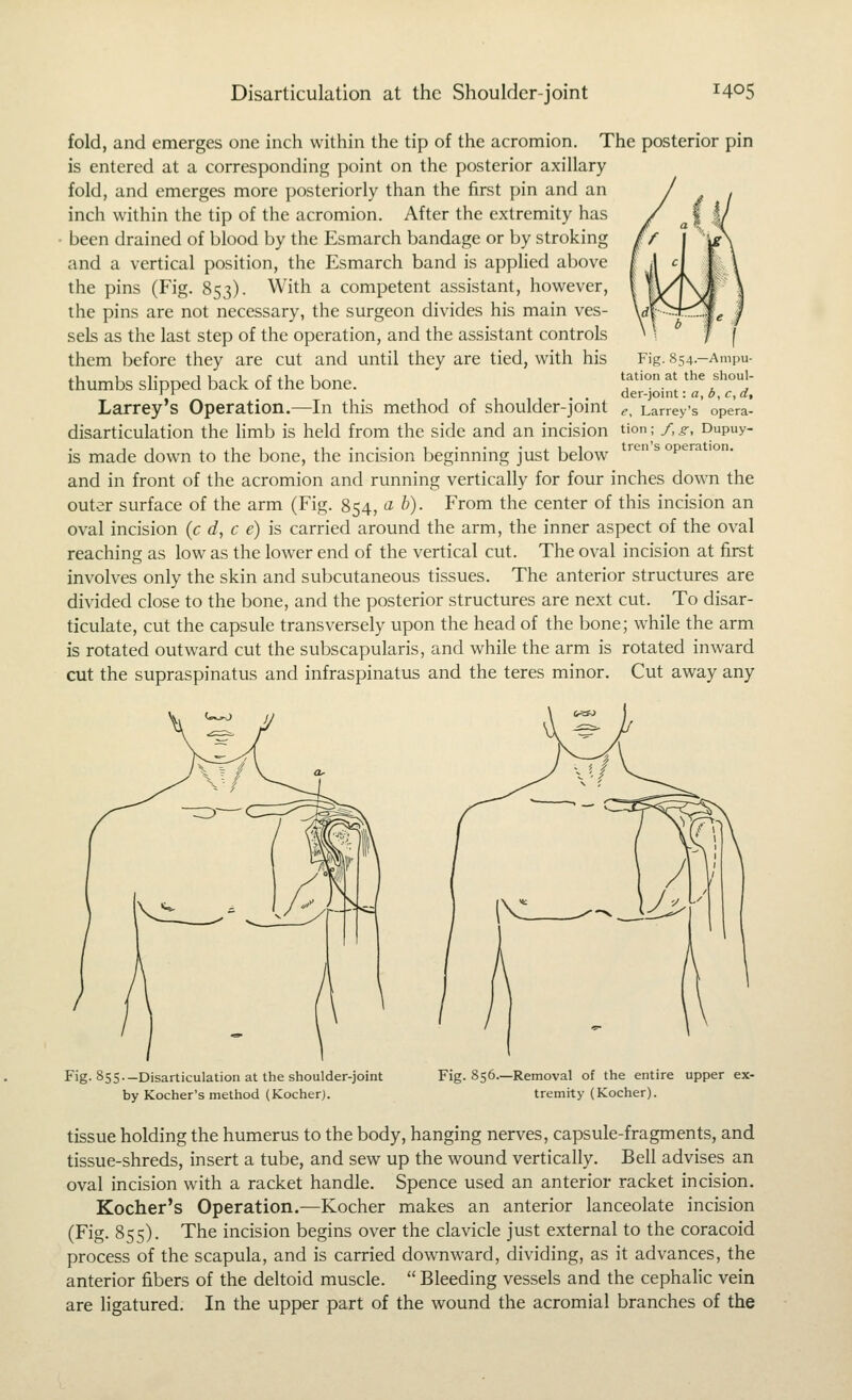 fold, and emerges one inch within the tip of the acromion. The posterior pin is entered at a corresponding point on the posterior axillary fold, and emerges more posteriorly than the first pin and an inch within the tip of the acromion. After the extremity has been drained of blood by the Esmarch bandage or by stroking and a vertical position, the Esmarch band is applied above the pins (Fig. 853). With a competent assistant, however, the pins are not necessary, the surgeon divides his main ves- sels as the last step of the operation, and the assistant controls them before they are cut and until they are tied, with his thumbs sHpped back of the bone. Larrey's Operation.—In this method of shoulder-joint disarticulation the hmb is held from the side and an incision is made down to the bone, the incision beginning just below and in front of the acromion and running vertically for four inches down the outer surface of the arm (Fig. 854, cl b). From the center of this incision an oval incision (c d, c e) is carried around the arm, the inner aspect of the oval reaching as low as the lower end of the vertical cut. The oval incision at first involves only the skin and subcutaneous tissues. The anterior structures are divided close to the bone, and the posterior structures are next cut. To disar- ticulate, cut the capsule transversely upon the head of the bone; while the arm is rotated outward cut the subscapularis, and while the arm is rotated inward cut the supraspinatus and infraspinatus and the teres minor. Cut away any Fig. 854.—Ampu- tation at the shoul- der-joint : a, i>, c, d, e, Larrey's opera- tion ; f, g, Dupuy- tren's operation. Fig. 855.-Disarticulation at the shoulder-joint by Kocher's method (Kocher). Fig. 856.—Removal of the entire upper ex- tremity (Kocher). tissue holding the humerus to the body, hanging nerves, capsule-fragments, and tissue-shreds, insert a tube, and sew up the wound vertically. Bell advises an oval incision with a racket handle. Spence used an anterior racket incision. Kocher's Operation.—Kocher makes an anterior lanceolate incision (Fig. 855). The incision begins over the clavicle just external to the coracoid process of the scapula, and is carried downward, dividing, as it advances, the anterior fibers of the deltoid muscle.  Bleeding vessels and the cephalic vein are ligatured. In the upper part of the wound the acromial branches of the