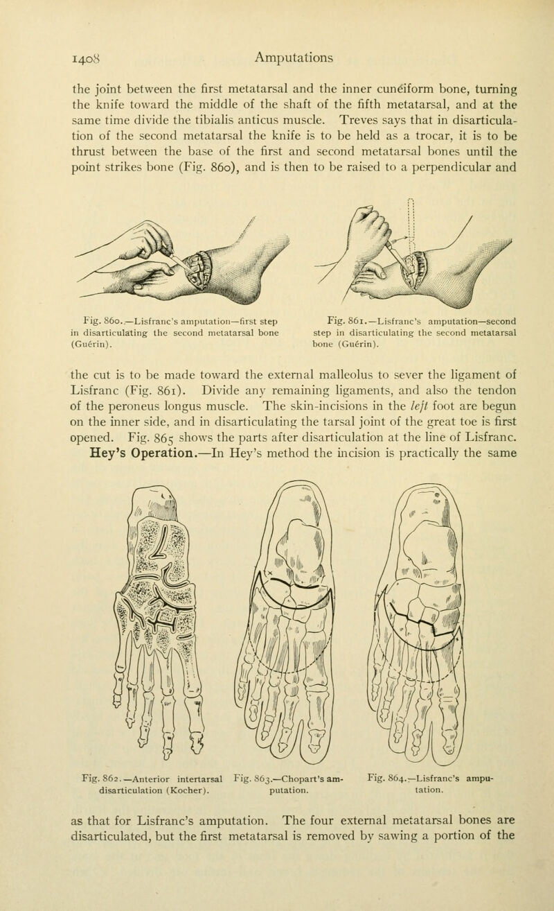 ihe joint between the first metatarsal and the inner cuneiform bone, turning the knife toward the middle of the shaft of the fifth metatarsal, and at the same time divide the tibialis anticus muscle. Treves says that in disarticula- tion of the second metatarsal the knife is to be held as a trocar, it is to be thrust between the base of the first and second metatarsal bones until the point strikes bone (Fig. 860), and is then to be raised to a perpendicular and Fig. 860.,—Lisfranc's amputation—first step in disarticulating the second metatarsal bone (Guerin). Fig. 861.—Lisfranc's amputation—second step in disarticulating the second metatarsal bone (Guerin). the cut is to be made toward the external malleolus to sever the ligament of Lisfranc (Fig. 861). Divide any remaining ligaments, and also the tendon of the peroneus longus muscle. The skin-incisions in the left foot are begun on the inner side, and in disarticulating the tarsal joint of the great toe is first opened. Fig. 865 shows the parts after disarticulation at the line of Lisfranc. Hey's Operation.—In Hey's method the incision is practically the same Fig. 862—Anterior intertarsal Fig. 863.—Chopart's am- disarticulation (Kocher). putation. Fig. 864.—Lisfranc's ampu- tation. as that for Lisfranc's amputation. The four external metatarsal bones are disarticulated, but the first metatarsal is removed by sawing a portion of the