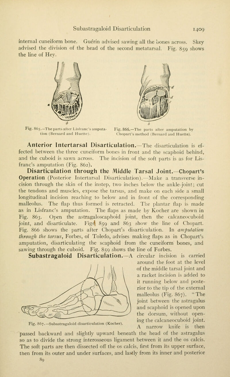 internal cuneiform bone. Guerin advised sawing all the bones across. Skey advised the division of the head of the second metatarsal. Fig. 859 shows the line of Hev. Fig. 865.—The parts after Lisfranc's amputa- tion (Bernard and Huette). Fig. 866.—The parts after amputation by Chopart's method (Bernard and Huette). Anterior Intertarsal Disarticulation.—The disarticulation is ef- fected between the three cuneiform bones in front and the scaphoid behind, and the cuboid is sawn across. The incision of the soft parts is as for Lis- franc's amputation (Fig. 862). Disarticulation through the Middle Tarsal Joint.—Chopart's Operation (Posterior Intertarsal Disarticulation).—Make a transverse in- cision through the skin of the instep, two inches below the ankle-joint; cut the tendons and muscles, expose the tarsus, and make on each side a small longitudinal incision reaching to below and in front of the corresponding malleolus. The flap thus formed is retracted. The plantar flap is made as in Lisfranc's amputation. The flaps as made by Kocher are shown in Fig. 863. Open the astragaloscaphoid joint, then the calcaneocuboid joint, and disarticulate. Figsj 859 and 863 show the line of Chopart. Fig. 866 shows the parts after Chopart's disarticulation. In amputation through the tarsus, Forbes, of Toledo, advises making flaps as in Chopart's amputation, disarticulating the scaphoid from the cuneiform bones, and sawing through the cuboid. Fig. 859 shoves the line of Forbes. Subastragaloid Disarticulation.—A circular incision is carried around the foot at the level of the middle tarsal joint and a racket incision is added to it running below and poste- rior to the tip of the external malleolus (Fig. 867). The joint between the astragalus and scaphoid is opened upon the dorsum, without open- ing the calcaneocuboid joint. A narrow knife is then passed backward and slightly upward beneath the head of the astragalus so as to divide the strong interosseous ligament between it and the os calcis. The soft parts are then dissected off the os calcis, first from its upper surface, then from its outer and under surfaces, and lastly from its inner and posterior Fig. 867.—Subastragaloid disarticulation (Kocher).