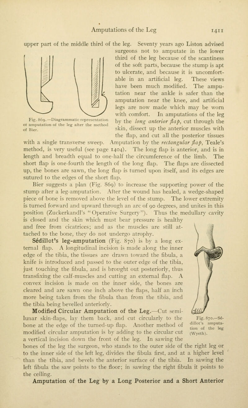 Fig. 869. —Diagrammatic representation ot amputation of the leg after the method of Bier. upper part of the middle third of the leg. Seventy years ago Listen advised surgeons not to amputate in the lower third of the leg because of the scantiness of the soft parts, because the stump is apt to ulcerate, and because it is uncomfort- able in an artificial leg. These views have been much modified. The ampu- tation near the ankle is safer than the amputation near the knee, and artificial legs are now made which may be worn with comfort. In amputations of the leg by the long anterior flap, cut through the skin, dissect up the anterior muscles with the flap, and cut all the posterior tissues with a single transverse sweep. Amputation by the rectangular flap, Teale's method, is ven,' useful (see page 1404). The long flap is anterior, and is in length and breadth equal to one-half the circumference of the limb. The short flap is one-fourth the length of the long flap. The flaps are dissected up, the bones are sawn, the long flap is turned upon itself, and its edges are sutured to the edges of the short flap. Bier suggests a plan (Fig. 86g) to increase the supporting power of the stump after a leg-amputation. After the wound has healed, a wedge-shaped piece of bone is removed above the level of the stump. The lower extremity is turned forward and upward through an arc of 90 degrees, and unites in this position (Zuckerkandl's Operative Surger}-). Thus the medullar}' ca\dty is closed and the skin which must bear pressure is healthy and free from cicatrices; and as the muscles are still at- tached to the bone, they do not undergo atrophy. Sedillot's leg-amputation (Fig. 870) is by a long ex- ternal flap. A longitudinal incision is made along the inner edge of the tibia, the tissues are drawn toward the fibula, a knife is introduced and passed to the outer edge of the tibia, just touching the fibula, and is brought out posteriorly, thus transfixing the calf-muscles and cutting an external flap. A convex incision is made on the inner side, the bones are cleared and are sawn one inch above the flaps, half an inch more being taken from the fibula than from the tibia, and the tibia being bevelled anteriorly. Modified Circular Amputation of the Leg.—Cut semi- lunar skin-flaps, lay them back, and cut circularly to the bone at the edge of the tumed-up flap. Another method of modified circular amputation is by adding to the circular cut a vertical incision down the front of the leg. In sawing the bones of the leg the surgeon, who stands to the outer side of the right leg or to the inner side of the left leg, di\ides the fibula first, and at a higher level than the tibia, and bevels the anterior surface of the tibia. In sawing the left fibula the saw points to the floor; in sawing the right fibula it points to the ceiling. Amputation of the Leg by a Long Posterior and a Short Anterior Fig. 870.—Se- dillot's amputa- tion of the leg (Wyeth).