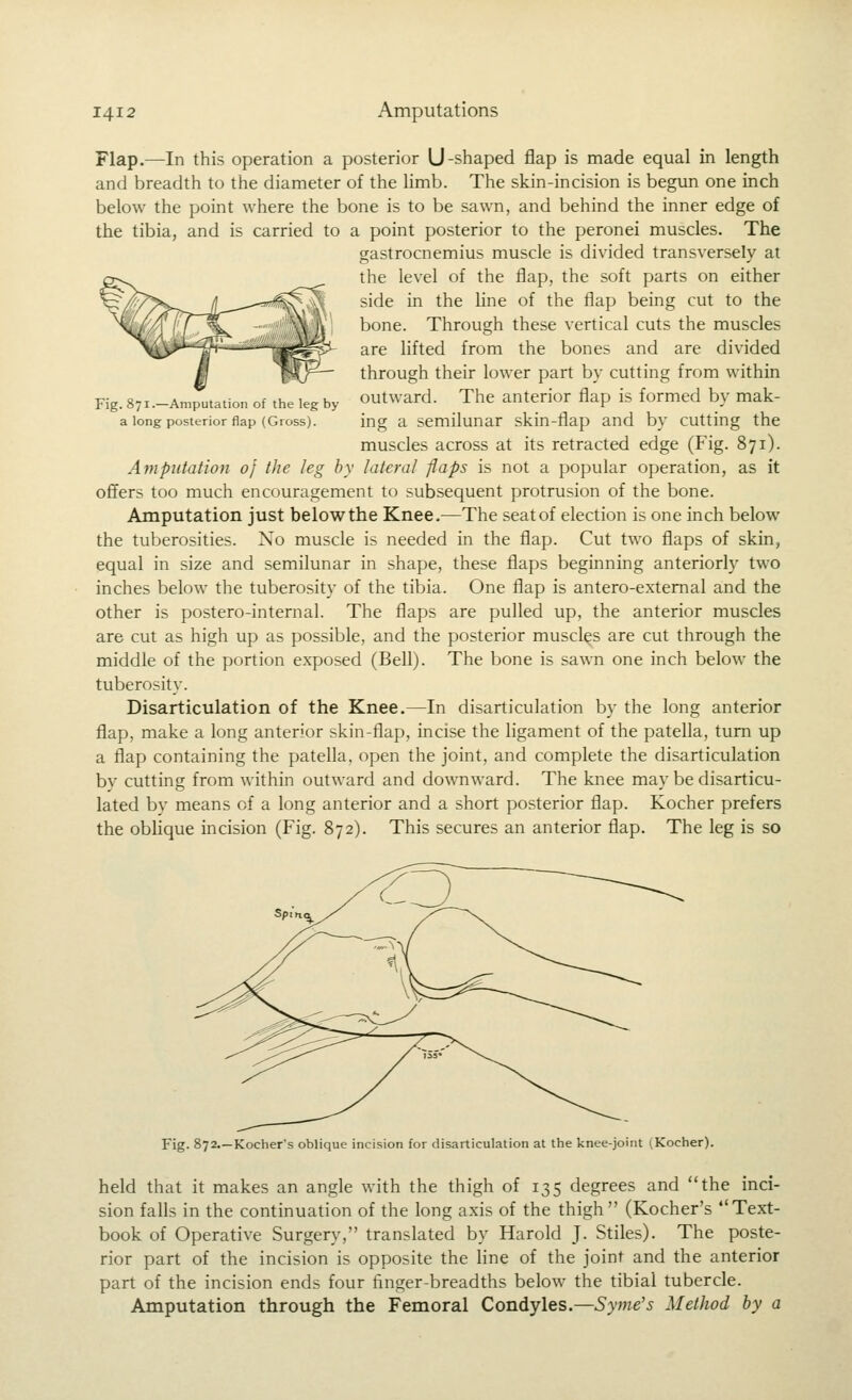 Fig. 871.—Amputation of the leg by a long posterior flap (Gross). Flap.—In this operation a posterior U-shaped flap is made equal in length and breadth to the diameter of the limb. The skin-incision is begvm one inch below the point where the bone is to be sawn, and behind the inner edge of the tibia, and is carried to a point posterior to the peronei muscles. The gastrocnemius muscle is divided transversely at the level of the flap, the soft parts on either side in the hne of the flap being cut to the bone. Through these vertical cuts the muscles are lifted from the bones and are divided through their lower part by cutting from within outward. The anterior flap is formed by mak- ing a semilunar skin-flap and by cutting the muscles across at its retracted edge (Fig. 871). Amputation oj the leg by lateral flaps is not a popular operation, as it offers too much encouragement to subsequent protrusion of the bone. Amputation just below the Knee.—The seat of election is one inch below the tuberosities. No muscle is needed in the flap. Cut two flaps of skin, equal in size and semilunar in shape, these flaps beginning anteriorly two inches below the tuberosity of the tibia. One flap is antero-extemal and the other is postero-internal. The flaps are pulled up, the anterior muscles are cut as high up as possible, and the posterior muscles are cut through the middle of the portion exposed (Bell). The bone is sawn one inch below the tuberosity. Disarticulation of the Knee.—In disarticulation by the long anterior flap, make a long anterior skin-flap, incise the ligament of the patella, turn up a flap containing the patella, open the joint, and complete the disarticulation by cutting from within outward and downward. The knee may be disarticu- lated by means of a long anterior and a short posterior flap. Kocher prefers the obHque incision (Fig. 872). This secures an anterior flap. The leg is so Fig. 872.—Kocher's oblique incision for disarticulation at the knee-joint (Kocher). held that it makes an angle with the thigh of 135 degrees and the inci- sion falls in the continuation of the long axis of the thigh (Kocher's Text- book of Operative Surgery, translated by Harold J. Stiles). The poste- rior part of the incision is opposite the line of the joint and the anterior part of the incision ends four finger-breadths below the tibial tubercle. Amputation through the Femoral Condyles.—Syme's Method by a