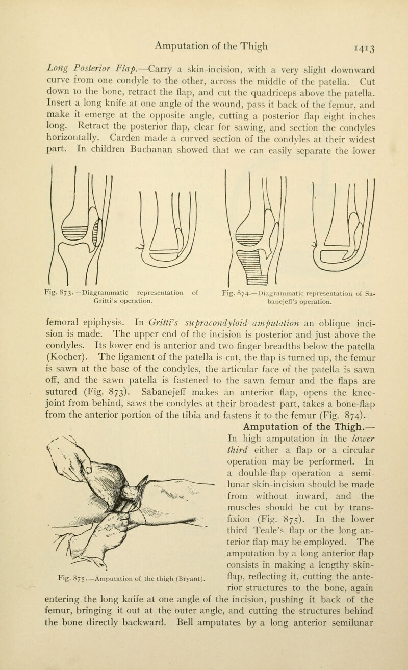 Long Posterior Flap.—Carry a skin-incision, with a very slight downward curve from one condyle to the other, across the middle of the patella. Cut down to the bone, retract the flap, and cut the quadriceps above the patella. Insert a long knife at one angle of the wound, pass it back of the femur, and make it emerge at the opposite angle, cutting a posterior flap eight inches long. Retract the posterior flap, clear for sawing, and section the condyles horizontally. Carden made a curved section of the condyles at their widest part. In children Buchanan showed that we can easily separate the lower Fig. 873. -Diagrammatic representation Gritti's operation. Fig. 874.—Diagrammatic representation of Sa- banejeff's operation. femoral epiphysis. In Gritti's supracondyloid amputation an oblique inci- sion is made. The upper end of the incision is posterior and just above the condyles. Its lower end is anterior and two finger-breadths below the patella (Kocher). The ligament of the patella is cut, the flap is turned up, the femur is sawn at the base of the condyles, the articular face of the patella is sawn off, and the sawn patella is fastened to the sawn femur and the flaps are sutured (Fig. 873). Sabanejeff makes an anterior flap, opens the knee- joint from behind, saws the condyles at their broadest part, takes a bone-flap from the anterior portion of the tibia and fastens it to the femur (Fig. 874). Amputation of the Thigh.— In high amputation in the lower third either a flap or a circular operation may be performed. In a double-flap operation a semi- lunar skin-incision should be made from without inward, and the muscles should be cut by trans- fixion (Fig. 875). In the lower third Teale's flap or the long an- terior flap may be employed. The amputation by a long anterior flap consists in making a lengthy skin- flap, reflecting it, cutting the ante- rior structures to the bone, again entering the long knife at one angle of the incision, pushing it back of the femur, bringing it out at the outer angle, and cutting the structures behind the bone directly backward. Bell amputates by a long anterior semilunar Fig. 875.—Amputation of the thigh (Bryant).