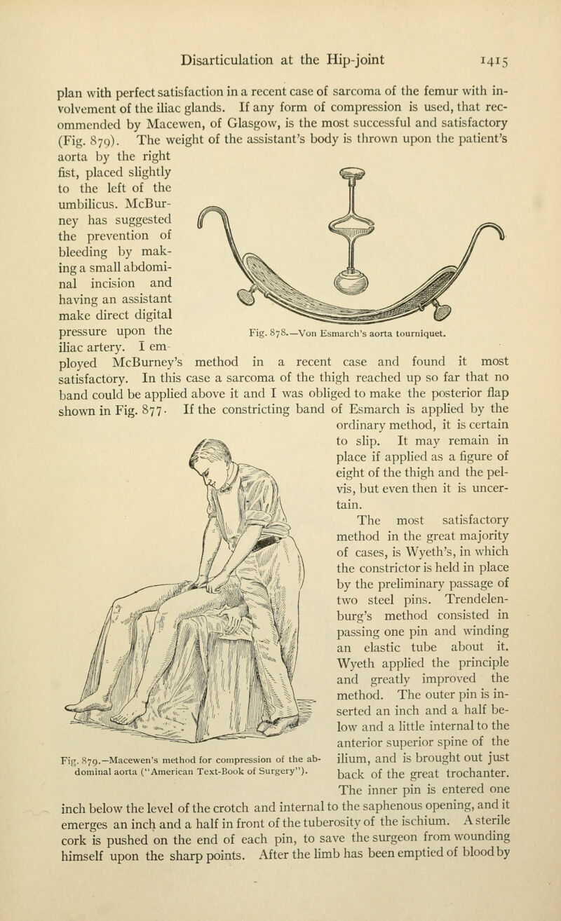 Fig. 878—Voii Esmaich's aorta tourniquet. plan with perfect satisfaction in a recent case of sarcoma of the femur with in- volvement of the ihac glands. If any form of compression is used, that rec- ommended by Macewen, of Glasgow, is the most successful and satisfactory (Fig. 879). The weight of the assistant's body is thrown upon the patient's aorta by the right fist, placed slightly to the left of the umbihcus. McBur- ney has suggested the prevention of bleeding by mak- ing a small abdomi- nal incision and having an assistant make direct digital pressure upon the ihac artery. I em- ployed McBurney's method in a recent case and found it most satisfactory. In this case a sarcoma of the thigh reached up so far that no band could be applied above it and I was obliged to make the posterior flap shown in Fig. 877. If the constricting band of Esmarch is applied by the ordinary method, it is certain to slip. It may remain in place if applied as a figure of eight of the thigh and the pel- vis, but even then it is uncer- tain. The most satisfactory method in the great majority of cases, is Wyeth's, in which the constrictor is held in place by the preliminary passage of two steel pins. Trendelen- burg's method consisted in passing one pin and winding an elastic tube about it. Wyeth applied the principle and greatly improved the method. The outer pin is in- serted an inch and a half be- low and a Httle internal to the anterior superior spine of the iUum, and is brought out just back of the great trochanter. The inner pin is entered one inch below the level of the crotch and internal to the saphenous opening, and it emerges an inch and a half in front of the tuberosity of the ischium. A sterile cork is pushed on the end of each pin, to save the surgeon from wounding himself upon the sharp points. After the Umb has been emptied of blood by Fig. S79.—Macewen's method for compression of the ab dominal aorta (American Text-Book of Surgery).