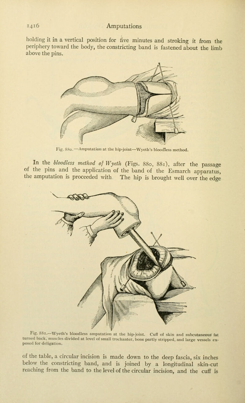 holding it in a vertical position for five minutes and stroking it from the periphery toward the body, the constricting band is fastened about the hmb above the pins. Fig. 880.—Amputation at the hip-joint—Wyeth's bloodless method. In the bloodless method of Wyeth (Figs. 880, 881), after the passage of the pins and the apphcation of the band of the Esmarch apparatus, the amputation is proceeded with The hip is brought well over the edge Fig. 881.—Wyeth's bloodless amputation at the hip-joint. Cuff of skin and subcutaneous fat turned back, muscles divided at level of small trochanter, bone partly stripped, and large vessels ex- posed for deligation. of the table, a circular incision is made down to the deep fascia, six inches below the constricting band, and is joined by a longitudinal skin-cut reaching from the band to the level of the circular incision, and the cuff is