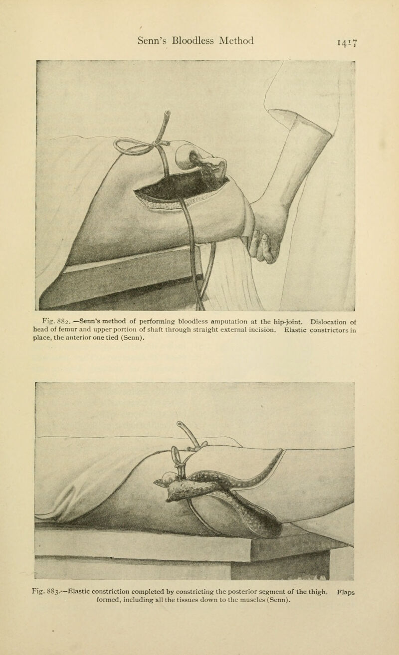 Senn's Bloodless Method W-' i V / / / / / i {i / ( i J Fig. S82.—Senn's method of performing bloodless amputation at the hip-joint. Dislocation of head of femur and upper portion of shaft through straight external incision. Elastic constrictors in place, the anterior one tied (Senn). * ■m.munii ■3*3{i«' Fig. 883.—Elastic constriction completed by constricting the posterior segment of the thigh. Flaps formed, including all the tissues down to the muscles (Senn).
