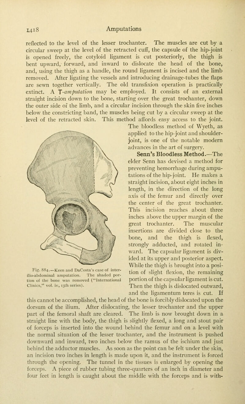 reflected to the level of the lesser trochanter. The muscles are cut by a circular sweep at the level of the retracted cuff, the capsule of the hip-joint is opened freely, the cotyloid ligament is cut posteriorly, the thigh is bent upward, forward, and inward to dislocate the head of the bone, and, using the thigh as a handle, the round ligament is incised and the limb removed. After ligating the vessels and introducing drainage-tubes the flaps are sewn together vertically. The old transfixion operation is practically extinct. A [-amputation may be employed. It consists of an external straight incision down to the bone, starting over the great trochanter, down the outer side of the limb, and a circular incision through the skin five inches below the constricting band, the muscles being cut by a circular sweep at the level of the retracted skin. This method affords easy access to the joint. The bloodless method of Wyeth, as applied to the hip-joint and shoulder- joint, is one of the notable modern advances in the art of surgery. Senn's Bloodless Method.—The elder Senn has devised a method for preventing hemorrhage during ampu- tations of the hip-joint. He makes a straight incision, about eight inches in length, in the direction of the long axis of the femur and directly over the center of the great trochanter. This incision reaches about three inches above the upper margin of the great trochanter. The muscular insertions are divided close to the bone, and the thigh is flexed, strongly adducted, and rotated in- ward. The capsular ligament is div- ided at its upper and posterior aspect. While the thigli is brought into a posi- tion of slight flexion, the remaining portion of the capsular ligament is cut. Then the thigh is dislocated outward, and the ligamentum teres is cut. If this cannot be accomplished, the head of the bone is forcibly dislocated upon the dorsum of the ilium. After dislocating, the lesser trochanter and the upper part of the femoral shaft are cleared. The limb is now brought down in a straight line with the body, the thigh is slightly flexed, a long and stout pair of forceps is inserted into the wound behind the femur and on a level with the normal situation of the lesser trochanter, and the instrument is pushed downward and inward, two inches below the ramus of the ischium and just behind the adductor muscles. As soon as the point can be felt under the skin, an incision two inches in length is made upon it, and the instrument is forced through the opening. The tunnel in the tissues is enlarged by opening the forceps. A piece of rubber tubing three-quarters of an inch in diameter and four feet in length is caught about the middle with the forceps and is with- Fig. 884.—Keen and DaCosta's case of inter- ilio-abdominal amputation. The shaded por- tion of the bone was removed (International Clinics, vol. iv, 13th series).