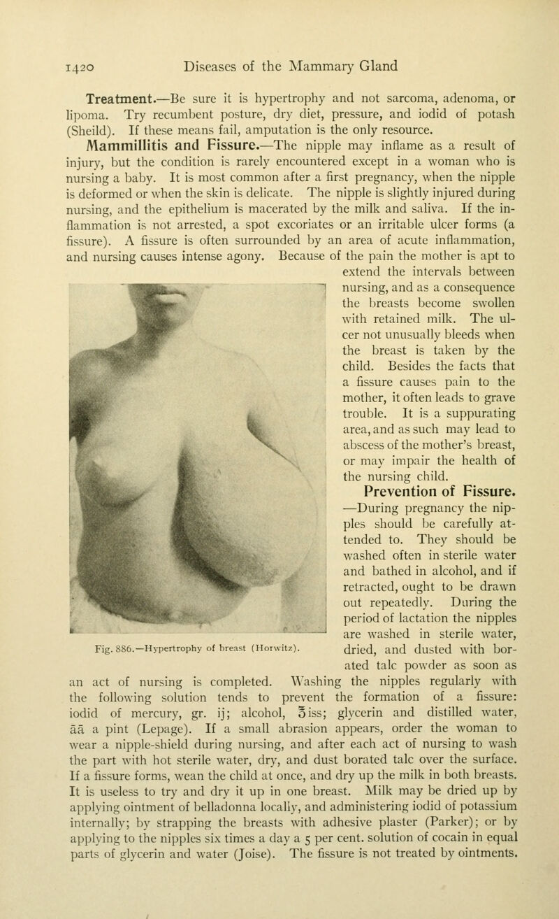 Treatment.—Be sure it is hypertrophy and not sarcoma, adenoma, or lipoma. Try recumbent posture, dry diet, pressure, and iodid of potash (Sheild). If these means fail, amputation is the only resource. Mammillitis and Fissure.—The nipple may inflame as a result of injury, but the condition is rarely encountered except in a woman who is nursing a baby. It is most common after a first pregnancy, when the nipple is deformed or when the skin is delicate. The nipple is slightly injured during nursing, and the epithelium is macerated by the milk and saliva. If the in- flammation is not arrested, a spot excoriates or an irritable ulcer forms (a fissure). A fissure is often surrounded by an area of acute inflammation, and nursing causes intense agony. Because of the pain the mother is apt to extend the intervals between nursing, and as a consequence the ijreasts become swollen with retained milk. The ul- cer not unusually bleeds when the breast is taken by the child. Besides the facts that a fissure causes pain to the mother, it often leads to grave trouble. It is a suppurating area, and as such may lead to abscess of the mother's breast, or may impair the health of the nursing child. Prevention of Fissure. —During pregnancy the nip- ples should be carefully at- tended to. They should be washed often in sterile water and bathed in alcohol, and if retracted, ought to be drawn out repeatedly. During the period of lactation the nipples are washed in sterile water, dried, and dusted with ber- ated talc powder as soon as an act of nursing is completed. Washing the nipples regularly with the following solution tends to prevent the formation of a fissure: iodid of mercury, gr. ij; alcohol, Siss; glycerin and distilled water, aa a pint (Lepage). If a small abrasion appears, order the woman to wear a nipple-shield during nursing, and after each act of nursing to wash the part with hot sterile water, dry, and dust borated talc over the surface. If a fissure forms, wean the child at once, and dry up the milk in both breasts. It is useless to try and dry it up in one breast. Milk may be dried up by applying ointment of belladonna locally, and administering iodid of potassium internally; by strapping the breasts with adhesive plaster (Parker); or by applying to the nipples six times a day a 5 per cent, solution of cocain in equal parts of glycerin and water (Joise). The fissure is not treated by ointments. Fig. 886.—Hypertrophy of breast (Hoiwitz).