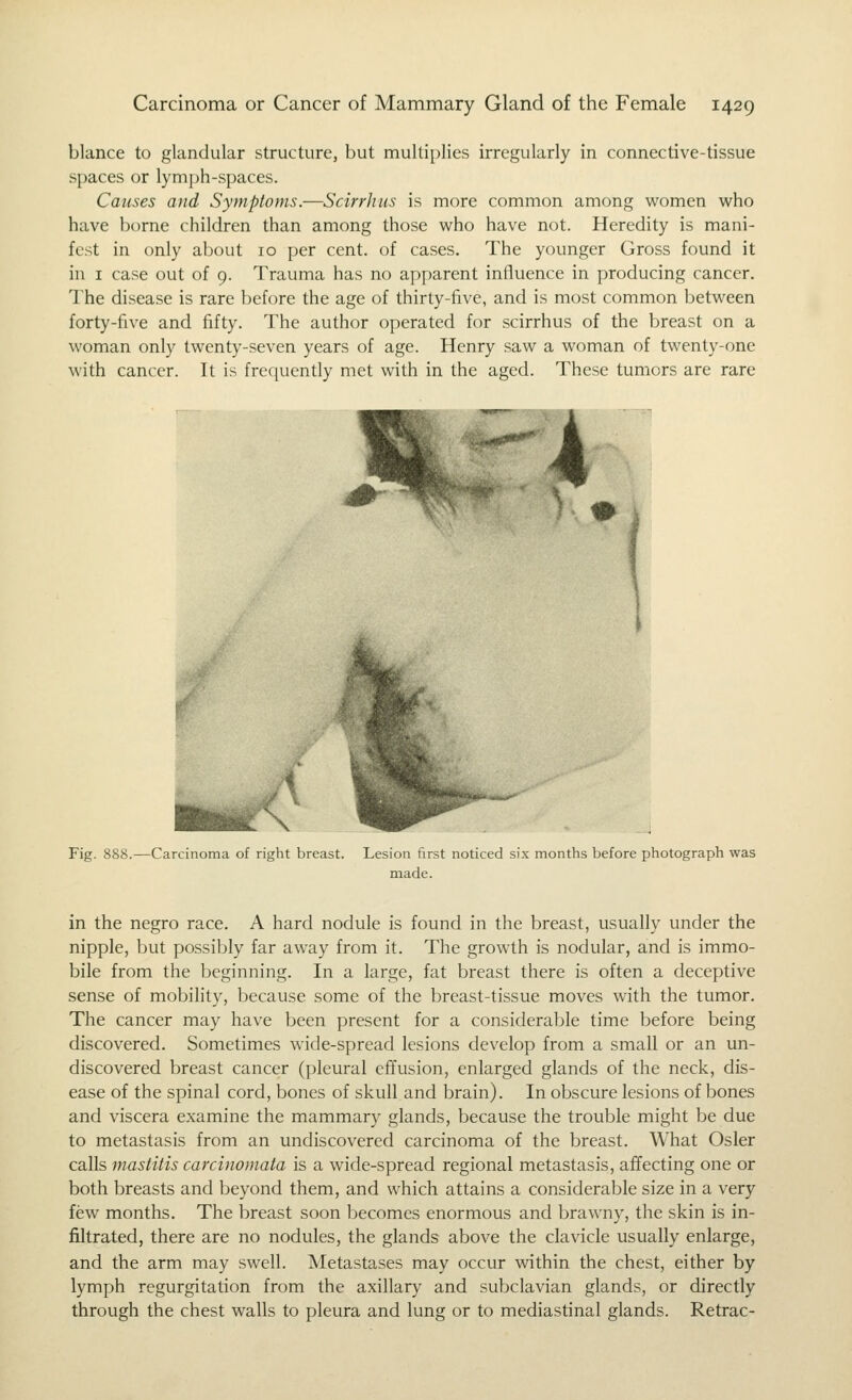 blance to glandular structure, but multiplies irregularly in connective-dssue spaces or lymph-spaces. Causes and Symptoms.—Scirrhus is more common among women who have borne children than among those who have not. Heredity is mani- fest in only about 10 per cent, of cases. The younger Gross found it in I case out of 9. Trauma has no apparent influence in producing cancer. The disease is rare before the age of thirty-five, and is most common between forty-five and fifty. The author operated for scirrhus of the breast on a woman only twenty-seven years of age. Henry saw a woman of twenty-one with cancer. It is frequently met with in the aged. These tumors are rare Fig. 888.—Carcinoma of right breast. Lesion first noticed six months before photograph was made. in the negro race. A hard nodule is found in the breast, usually under the nipple, but possibly far away from it. The growth is nodular, and is immo- bile from the beginning. In a large, fat breast there is often a deceptive sense of mobility, because some of the breast-tissue moves with the tumor. The cancer may have been present for a considerable time before being discovered. Sometimes wide-spread lesions develop from a small or an un- discovered breast cancer (pleural effusion, enlarged glands of the neck, dis- ease of the spinal cord, bones of skull and brain). In obscure lesions of bones and viscera examine the mammary glands, because the trouble might be due to metastasis from an undiscovered carcinoma of the breast. What Osier calls mastitis carcinomata is a wide-spread regional metastasis, affecting one or both breasts and beyond them, and which attains a considerable size in a very few months. The breast soon liecomes enormous and brawny, the skin is in- filtrated, there are no nodules, the glands above the clavicle usually enlarge, and the arm may swell. Metastases may occur within the chest, either by lymph regurgitation from the axillary and subclavian glands, or directly through the chest walls to pleura and lung or to mediastinal glands. Retrac-