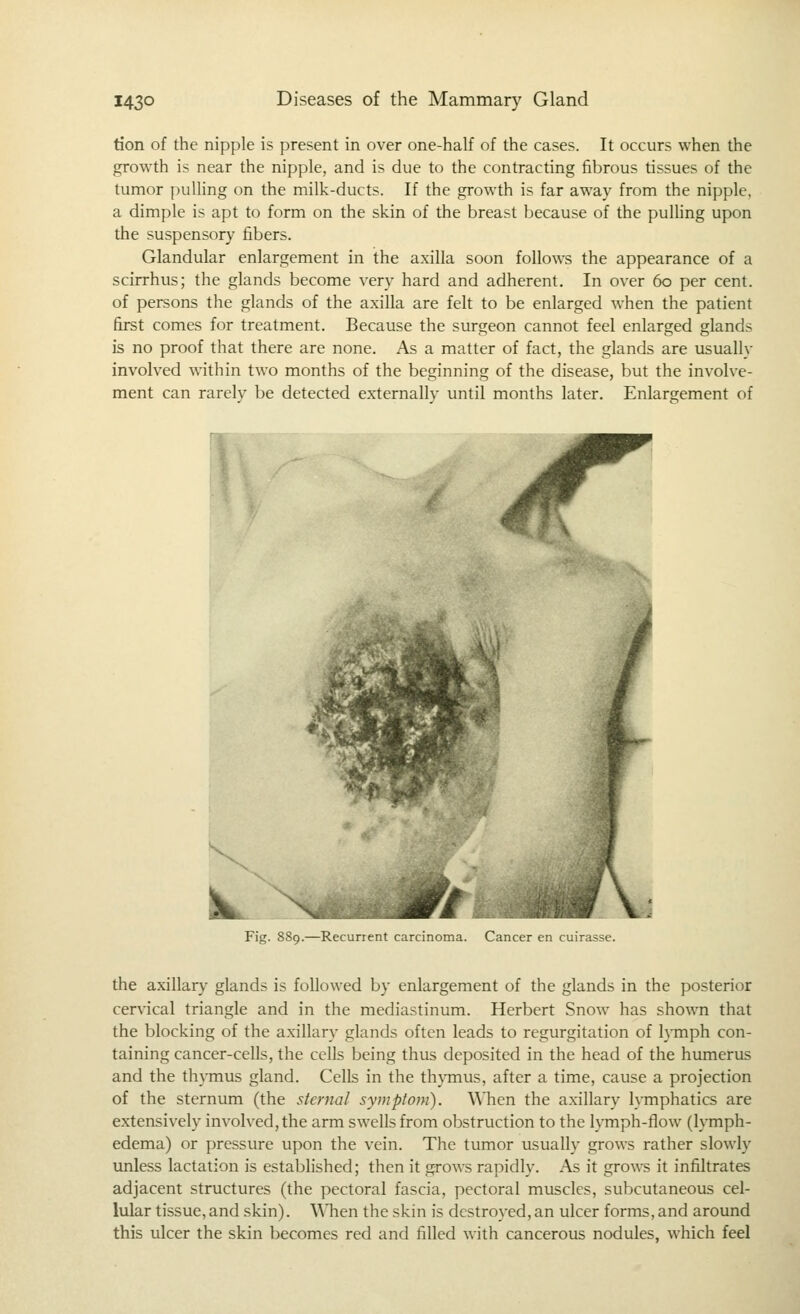 tion of the nipple is present in over one-half of the cases. It occurs when the growth is near the nipple, and is due to the contracting fibrous tissues of the tumor puUing on the milk-ducts. If the growth is far away from the nipple, a dimple is apt to form on the skin of the breast because of the puUing upon the suspensory fibers. Glandular enlargement in the axilla soon follows the appearance of a scirrhus; the glands become very hard and adherent. In over 60 per cent, of persons the glands of the axilla are feh to be enlarged when the patient first comes for treatment. Because the surgeon cannot feel enlarged glands is no proof that there are none. As a matter of fact, the glands are usually involved within two months of the beginning of the disease, but the involve- ment can rarely be detected externally until months later. Enlargement of Fig. SS9.—Recurient carcinoma. Cancer en cuirasse. the axillary glands is followed by enlargement of the glands in the posterior cervical triangle and in the mediastinum. Herbert Snow has shown that the blocking of the axillary glands often leads to regurgitation of lymph con- taining cancer-cells, the cells being thus deposited in the head of the humerus and the thymus gland. Cells in the th}Tnus, after a time, cause a projection of the sternum (the sternal symptom). \\*hen the axillary lymphatics are extensively involved, the arm swells from obstruction to the lymph-flow (lymph- edema) or pressure upon the vein. The tumor usually grows rather slowly unless lactation is established; then it grows rapidly. As it grows it infiltrates adjacent structures (the pectoral fascia, pectoral muscles, subcutaneous cel- lular tissue,and skin). \\'hen the skin is destroyed, an ulcer forms, and around this ulcer the skin becomes red and filled with cancerous nodules, which feel