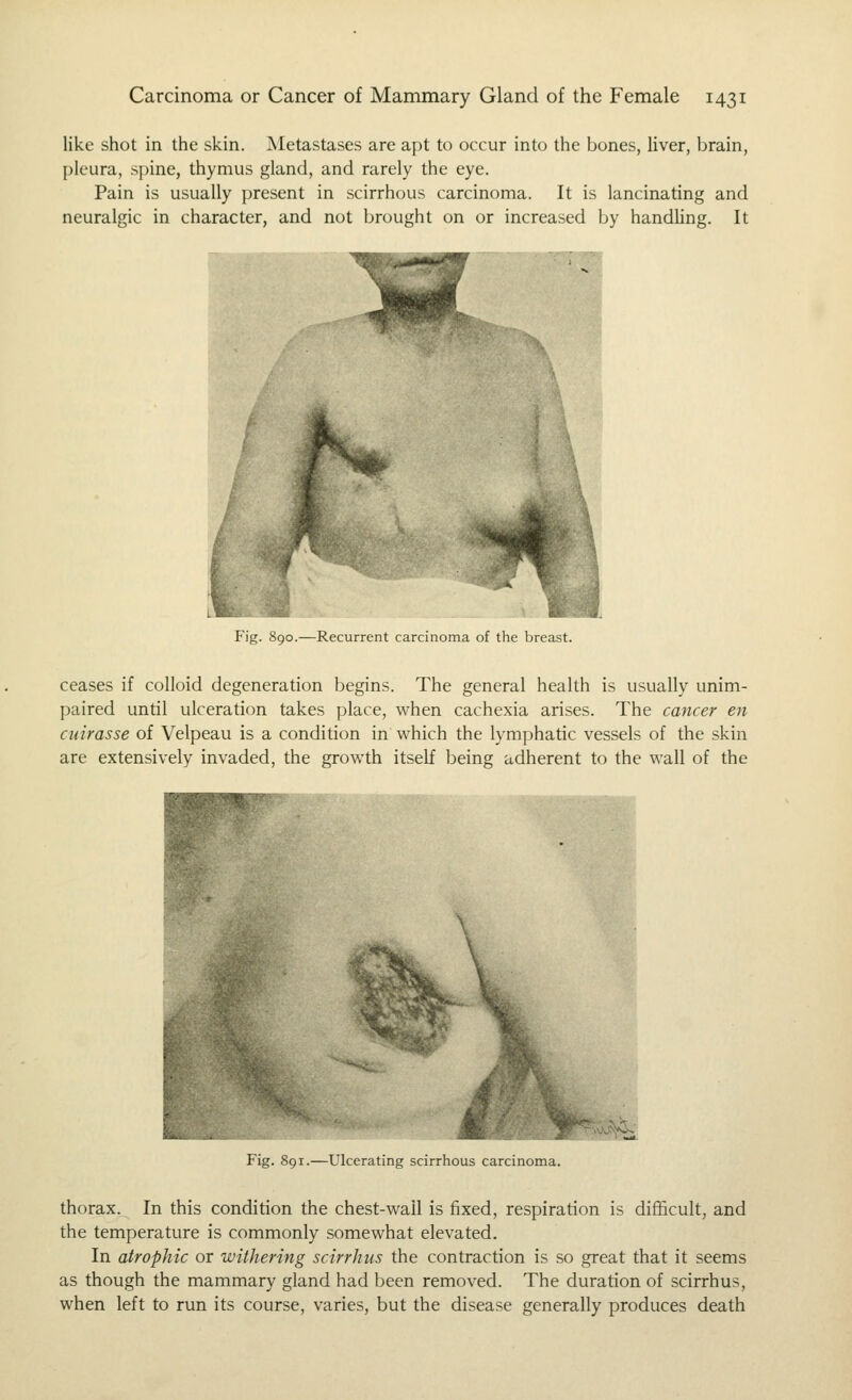 like shot in the skin. Metastases are apt to occur into the bones, liver, brain, pleura, spine, thymus gland, and rarely the eye. Pain is usually present in scirrhous carcinoma. It is lancinating and neuralgic in character, and not brought on or increased by handling. It Fig. 890.—Recurrent carcinoma of the breast. ceases if colloid degeneration begins. The general health is usually unim- paired until ulceration takes place, when cachexia arises. The cancer en cuirasse of Velpeau is a condition in which the lymphatic vessels of the skin are extensively invaded, the growth itself being adherent to the wall of the Fig. 891.—Ulcerating scirrhous carcinoma. thorax. In this condition the chest-wall is fixed, respiration is difficult, and the temperature is commonly somewhat elevated. In atrophic or withering scirrhus the contraction is so great that it seems as though the mammary gland had been removed. The duration of scirrhus, when left to run its course, varies, but the disease generally produces death