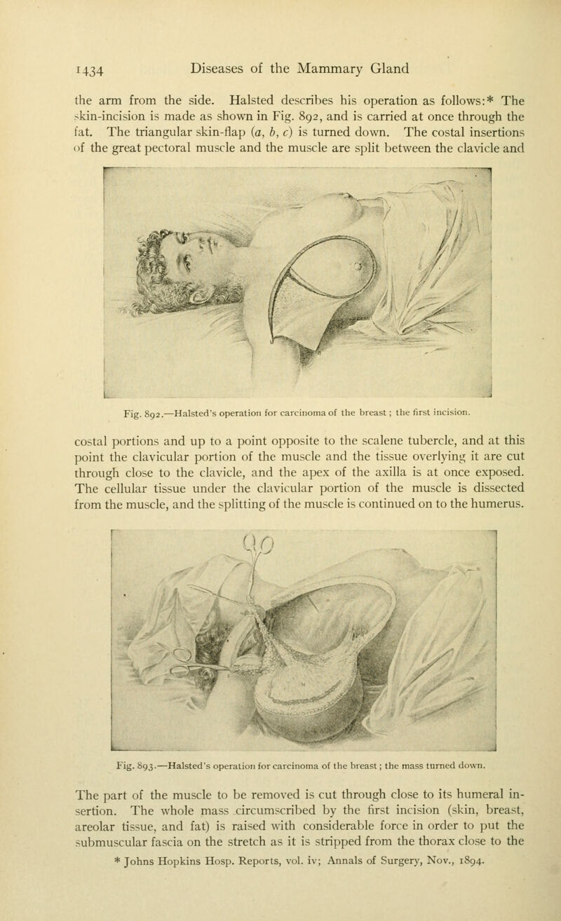 the arm from the side. Hals ted describes his operation as follows:* The skin-incision is made as shown in Fig. 892, and is carried at once through the fat. The triangular skin-flap (a, b, c) is turned down. The costal insertions of the great pectoral muscle and the muscle are spht between the clavicle and r^' J Fig. 892.—Halsted's operation for carcinoma of the breast ; the first incision. costal portions and up to a point opposite to the scalene tubercle, and at this point the clavicular portion of the muscle and the tissue overlying it are cut through close to the clavicle, and the apex of the axilla is at once exposed. The cellular tissue under the clavicular portion of the muscle is dissected from the muscle, and the splitting of the muscle is continued on to the humerus. r C! n Fig. 893.—Halsted's operation for carcinoma of the breast; the mass turned down. The part of the muscle to be removed is cut through close to its humeral in- sertion. The whole mass circumscribed by the first incision (skin, breast, areolar tissue, and fat) is raised with considerable force in order to put the submuscular fascia on the stretch as it is stripped from the thorax close to the * Johns Hopkins Hosp. Reports, vol. iv; Annals of Surgery, Nov., 1S94.