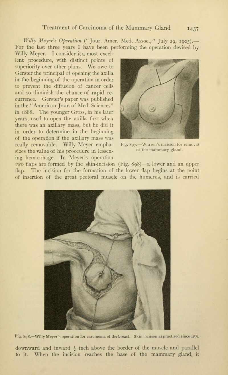 Willy Meyer's Operation (Jour. Amer. ^led. Assoc, July 29, 1905).— For the last three years I have been performing the operation devised by Willy Meyer. I consider it a most excel- lent procedure, with distinct points of superiority over other plans. We owe to Gerster the principal of opening the axilla in the beginning of the operation in order to prevent the diffusion of cancer cells and so diminish the chance of rapid re- currence. Gerster's paper was pubHshed in the American Jour, of Med. Sciences in 1888. The younger Gross, in his later years, used to open the axilla first when there was an axillary mass, but he did it in order to determine in the beginning of the operation if the axillary mass was really removable. Willy ]Meyer empha- Fig. 897 sizes the value of his procedure in lessen- ing hemorrhage. In Meyer's operation two flaps are formed by the skin-incision (Fig. 898)—a lower and an upper flap. The incision for the formation of the lower flap begins at the point of insertion of the great pectoral muscle on the humerus, and is carried .—W'.irrcn'^ incision for removal of the mammary gland. Fig. 8q8.—Willy Meyer's operation for carcinc oreast. Skin incision as practised since 1898. downward and inward h inch above the border of the muscle and parallel to it. When the incision reaches the base of the mammary gland, it