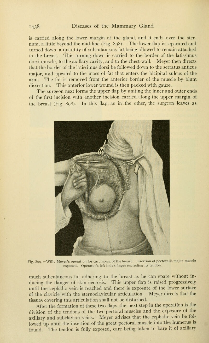 is carried along the lower margin of the gland, and it ends over the ster- num, a little beyond the mid-Hne (Fig. 898). The lower flap is separated and turned down, a quantity of subcutaneous fat being allowed to remain attached to the breast. This turning down is carried to the border of the latissimus dorsi muscle, to the axillary cavity, and to the chest-wall. Meyer then directs that the border of the latissimus dorsi be followed down to the serratus anticus major, and upward to the mass of fat that enters the bicipital sulcus of the arm. The fat is removed from the anterior border of the muscle by blunt dissection. This anterior lower wound is then packed with gauze. The surgeon next forms the upper flap by uniting the inner and outer ends of the first incision with another incision carried along the upper margin of the breast (Fig. 898). In this flap, as in the other, the surgeon leaves as Fig. 8gQ.—Willy Meyer's operation for carcinoma of the breast. Insertion of pectoralis major muscle exposed. Operator's left index-finger encircling its tendon. much subcutaneous fat adhering to the breast as he can spare without in- ducing the danger of skin-necrosis. This upper flap is raised progressively until the cephalic vein is reached and there is exposure of the lower surface of the clavicle with the sternoclavicular articulation. Meyer directs that the tissues covering this articulation shall not be disturbed. After the formation of these two flaps the next step in the operation is the division of the tendons of the two pectoral muscles and the exposure of the axillary and subclavian veins. Meyer advises that the cephalic vein be fol- lowed up until the insertion of the great pectoral muscle into the humerus is found. The tendon is fully exposed, care being taken to bare it of axillary