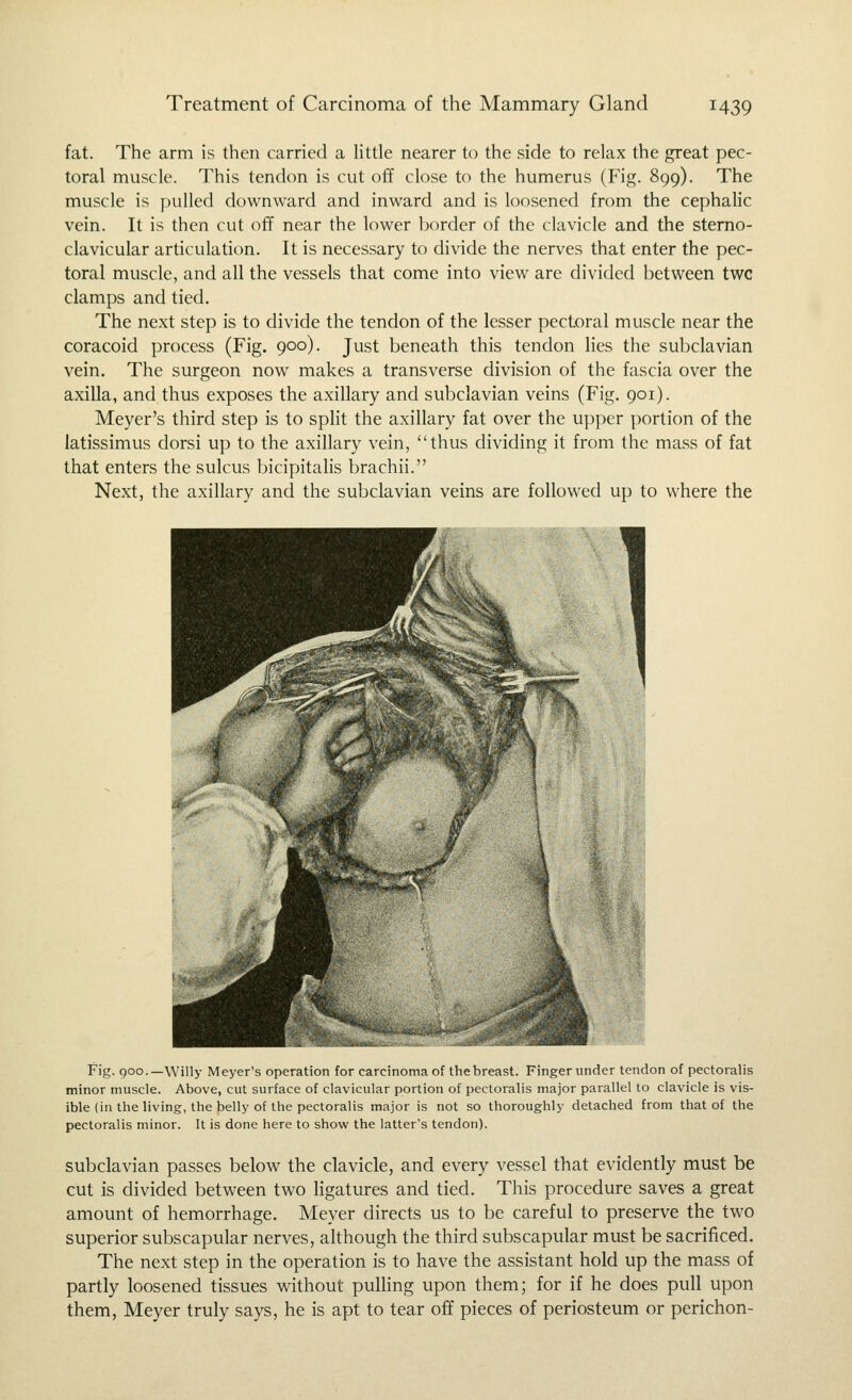 fat. The arm is then carried a Httle nearer to the side to relax the great pec- toral muscle. This tendon is cut off close to the humerus (Fig. 899). The muscle is pulled downward and inward and is loosened from the cephalic vein. It is then cut off near the lower border of the clavicle and the sterno- clavicular articulation. It is necessary to divide the nerves that enter the pec- toral muscle, and all the vessels that come into view are divided between twc clamps and tied. The next step is to divide the tendon of the lesser pectoral muscle near the coracoid process (Fig. 900). Just beneath this tendon lies the subclavian vein. The surgeon now makes a transverse division of the fascia over the axilla, and thus exposes the axillary and subclavian veins (Fig. 901). Meyer's third step is to split the axillary fat over the upper portion of the latissimus dorsi up to the axillary vein, thus dividing it from the mass of fat that enters the sulcus bicipitalis brachii. Next, the axillary and the subclavian veins are followed up to where the Fig. 900.—\Villy Meyer's operation for carcinoma of the breast. Finger under tendon of pectoralis minor muscle. Above, cut surface of clavicular portion of pectoralis major parallel to clavicle is vis- ible (in the living, the belly of the pectoralis major is not so thoroughly detached from that of the pectoralis minor. It is done here to show the latter's tendon). subclavian passes below the clavicle, and every vessel that evidently must be cut is divided between two ligatures and tied. This procedure saves a great amount of hemorrhage. Meyer directs us to be careful to preserve the two superior subscapular nerves, although the third subscapular must be sacrificed. The next step in the operation is to have the assistant hold up the mass of partly loosened tissues without pulling upon them; for if he does pull upon them, Meyer truly says, he is apt to tear off pieces of periosteum or perichon-