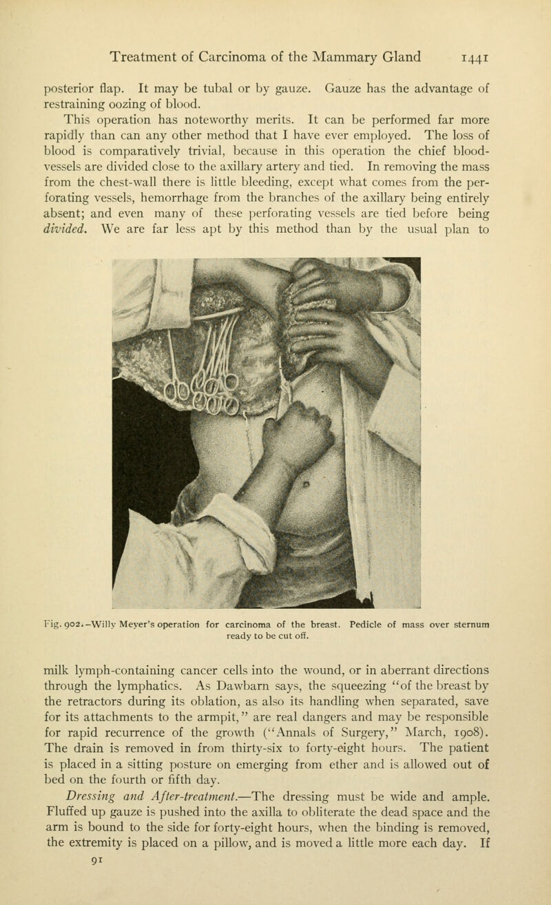 posterior flap. It may be tubal or by gauze. Gauze has the advantage of restraining oozing of blood. This operation has noteworthy merits. It can be performed far more rapidly than can any other method that I have ever employed. The loss of blood is comparatively trivial, because in this operation the chief blood- vessels are divided close to the axillary artery and tied. In removing the mass from the chest-wall there is httle bleeding, except what comes from the per- forating vessels, hemorrhage from the branches of the axillary being entirely absent; and even many of these perforating vessels are tied before being divided. We are far less apt by this method than by the usual plan to Fig. 902.-Willy Meyer's operation for carcinoma of the breast. ready to be cut off. Pedicle of mass over sternum milk lymph-containing cancer cells into the wound, or in aberrant directions through the lymphatics. As Dawbarn says, the squeezing of the breast by the retractors during its oblation, as also its handling when separated, save for its attachments to the armpit, are real dangers and may be responsible for rapid recurrence of the growth (Annals of Surgery, March, 1908). The drain is removed in from thirty-six to forty-eight hours. The patient is placed in a sitting posture on emerging from ether and is allowed out of bed on the fourth or fifth day. Dressing and After-treatment.—The dressing must be wide and ample. Fluffed up gauze is pushed into the axilla to obhterate the dead space and the arm is bound to the side for forty-eight hours, when the binding is removed, the extremity is placed on a pillow, and is moved a little more each day. If 91