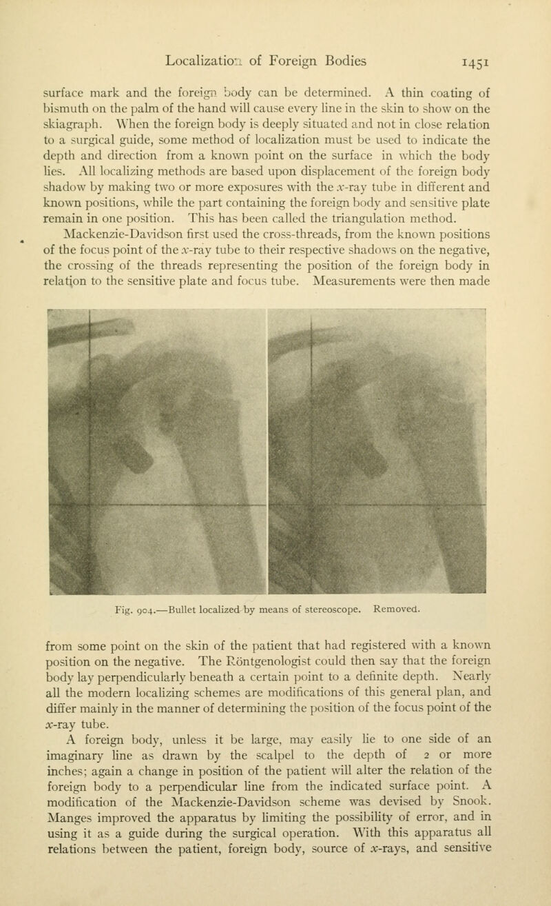 surface mark and the foreign body can be determined. A thin coating of bismuth on the palm of the hand will cause every line in the skin to show on the skiagraph. When the foreign body is deeply situated and not in close reladon to a surgical guide, some method of localization must be used to indicate the depth and direction from a known point on the surface in which the body lies. All localizing methods are based upon displacement of the foreign body shadow by making two or more exposures ^vith the .v-ray tube in different and known positions, while the part containing the foreign body and sensitive plate remain in one position. This has been called the triangulation method. Mackenzie-Davidson first used the cross-threads, from the known positions of the focus point of the .v-ray tube to their respective shadows on the negative, the crossing of the threads representing the position of the foreign body in relation to the sensitive plate and focus tube. Measurements were then made Fig. 904.—Bullet localized by means of stereoscope. RLinoved. from some point on the skin of the patient that had registered with a known position on the negative. The Rontgenologist could then say that the foreign body lay perpendicularly beneath a certain point to a definite depth. Nearly all the modern localizing schemes are modifications of this general plan, and diff'er mainly in the manner of determining the position of the focus point of the 5c-ray tube. A foreign body, unless it be large, may easily lie to one side of an imaginary line as drawn by the scalpel to the depth of 2 or more inches; again a change in position of the patient will alter the relation of the foreign body to a perpendicular line from the indicated surface point. A modification of the Mackenzie-Davidson scheme was devised by Snook. Manges improved the apparatus by limiting the possibility of error, and in using it as a guide during the surgical operation. With this apparatus all relations between the patient, foreign body, source of x-rays, and sensitive