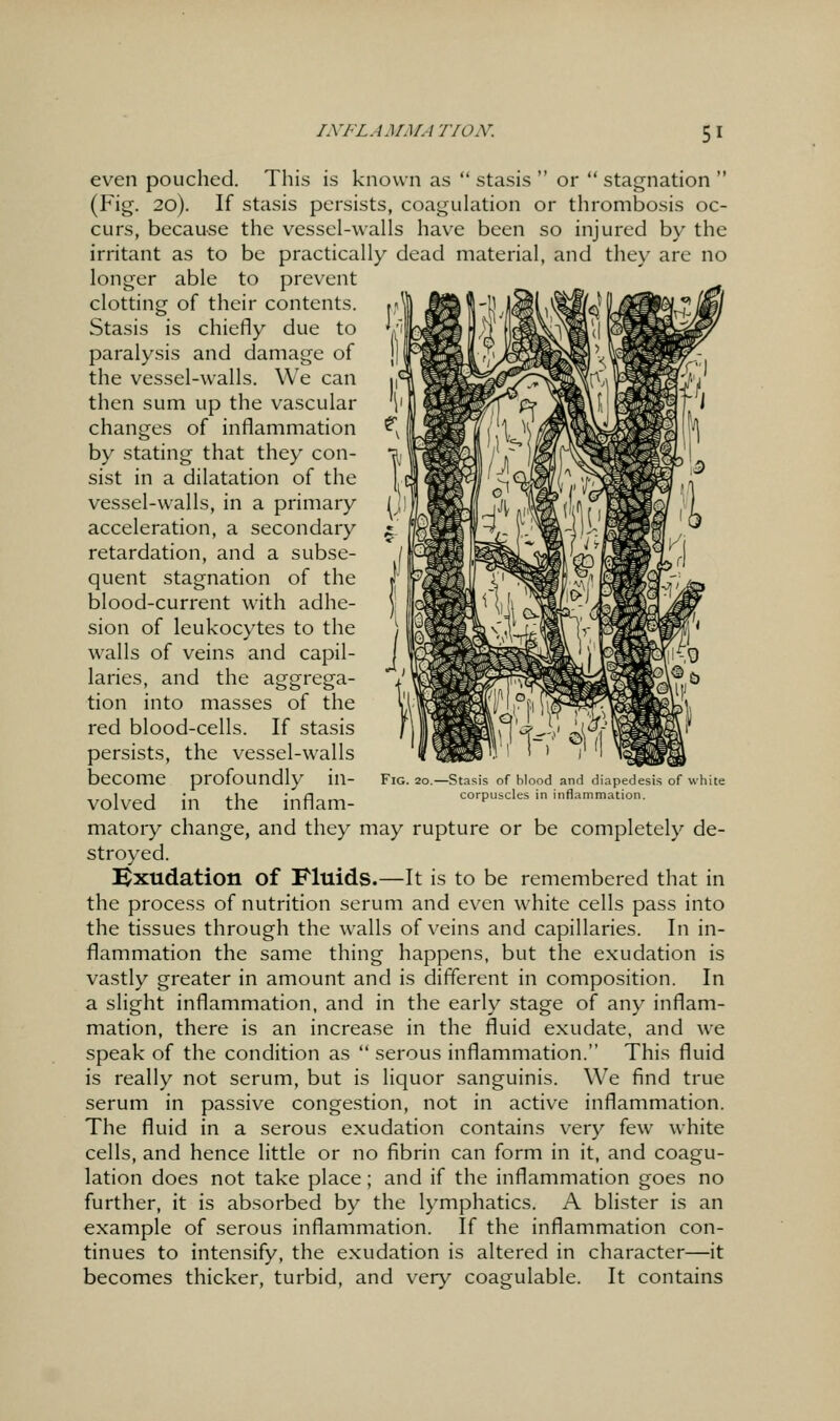 even pouched. This is known as  stasis  or  stagnation  (Fig. 20). If stasis persists, coagulation or thrombosis oc- curs, because the vessel-walls hav^e been so injured by the irritant as to be practically dead material, and they are no longer able to prevent clotting of their contents. -^^ Stasis is chiefly due to paralysis and damage of the vessel-walls. We can then sum up the vascular changes of inflammation by stating that they con- sist in a dilatation of the vessel-walls, in a primary acceleration, a secondary retardation, and a subse- quent stagnation of the blood-current with adhe- sion of leukocytes to the walls of veins and capil- laries, and the aggrega- tion into masses of the red blood-cells. If stasis persists, the vessel-walls become profoundly in- volved in the inflam- matoiy change, and they may rupture or be completely de- stroyed. Bxudation of Fluids.—It is to be remembered that in the process of nutrition serum and even white cells pass into the tissues through the walls of veins and capillaries. In in- flammation the same thing happens, but the exudation is vastly greater in amount and is different in composition. In a slight inflammation, and in the early stage of any inflam- mation, there is an increase in the fluid exudate, and we speak of the condition as  serous inflammation. This fluid is really not serum, but is liquor sanguinis. We find true serum in passive congestion, not in active inflammation. The fluid in a serous exudation contains very few white cells, and hence little or no fibrin can form in it, and coagu- lation does not take place; and if the inflammation goes no further, it is absorbed by the lymphatics. A blister is an example of serous inflammation. If the inflammation con- tinues to intensify, the exudation is altered in character—it becomes thicker, turbid, and very coagulable. It contains Fig. 2o.—Stasis of blood and diapedesis of white corpuscles in inflammation.