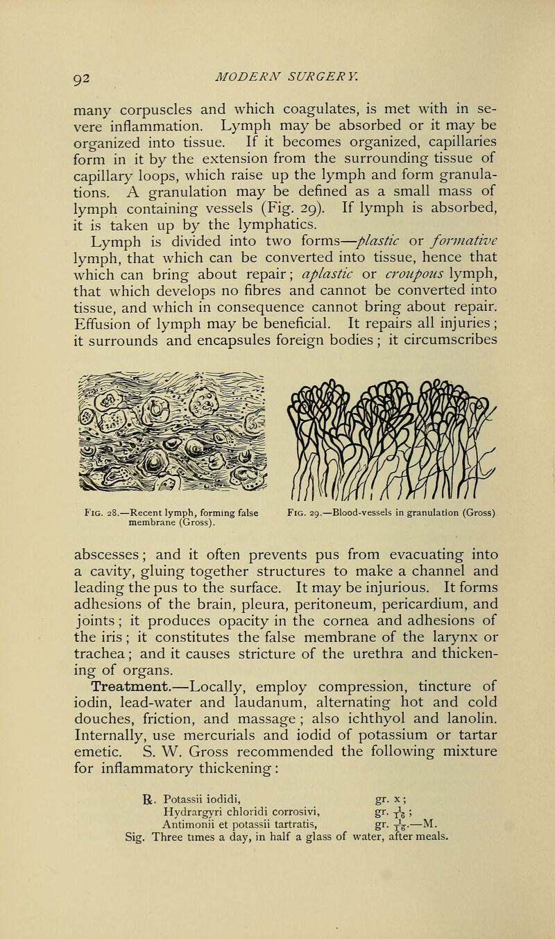 many corpuscles and which coagulates, is met with in se- vere inflammation. Lymph may be absorbed or it may be organized into tissue. If it becomes organized, capillaries form in it by the extension from the surrounding tissue of capillary loops, which raise up the lymph and form granula- tions. A granulation may be defined as a small mass of lymph containing vessels (Fig. 29). If lymph is absorbed, it is taken up by the lymphatics. Lymph is divided into two forms—plastic or foruiative lymph, that which can be converted into tissue, hence that which can bring about repair; aplastic or croupous lymph, that which develops no fibres and cannot be converted into tissue, and which in consequence cannot bring about repair. Effusion of lymph may be beneficial. It repairs all injuries; it surrounds and encapsules foreign bodies ; it circumscribes Pig. 28.—Recent lymph, forming false membrane (Gross). Fig. 29.—Blood-vessels in granulation (Gross) abscesses; and it often prevents pus from evacuating into a cavity, gluing together structures to make a channel and leading the pus to the surface. It may be injurious. It forms adhesions of the brain, pleura, peritoneum, pericardium, and joints; it produces opacity in the cornea and adhesions of the iris; it constitutes the false membrane of the larynx or trachea; and it causes stricture of the urethra and thicken- ing of organs. Treatment.—Locally, employ compression, tincture of iodin, lead-water and laudanum, alternating hot and cold douches, friction, and massage ; also ichthyol and lanolin. Internally, use mercurials and iodid of potassium or tartar emetic. S. W. Gross recommended the following mixture for inflammatory thickening: R. Potassii iodidi, gr. x; Hydrargyri chloiidi corrosivi, gr. j^g ; Antimonii et potassii tartratis, gr. J^.—M. Sig. Three times a day, in half a glass of water, after meals.