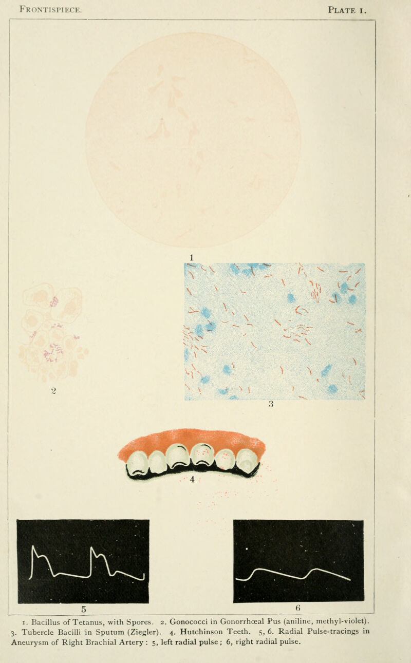 Frontispiece. Plate i. K - / 3. 'iv. . \ \ I. Bacillus of Tetanus, with Spores. 2. Gonococci in Gonorrhoeal Pus (aniline, methyl-violet). 3. Tubercle Bacilli in Sputum (Ziegler). 4. Hutchinson Teeth. 5, 6. Radial Pulse-tracings in Aneurysm of Right Brachial Artery : 5, left radial pulse; 6, right radial pulse.