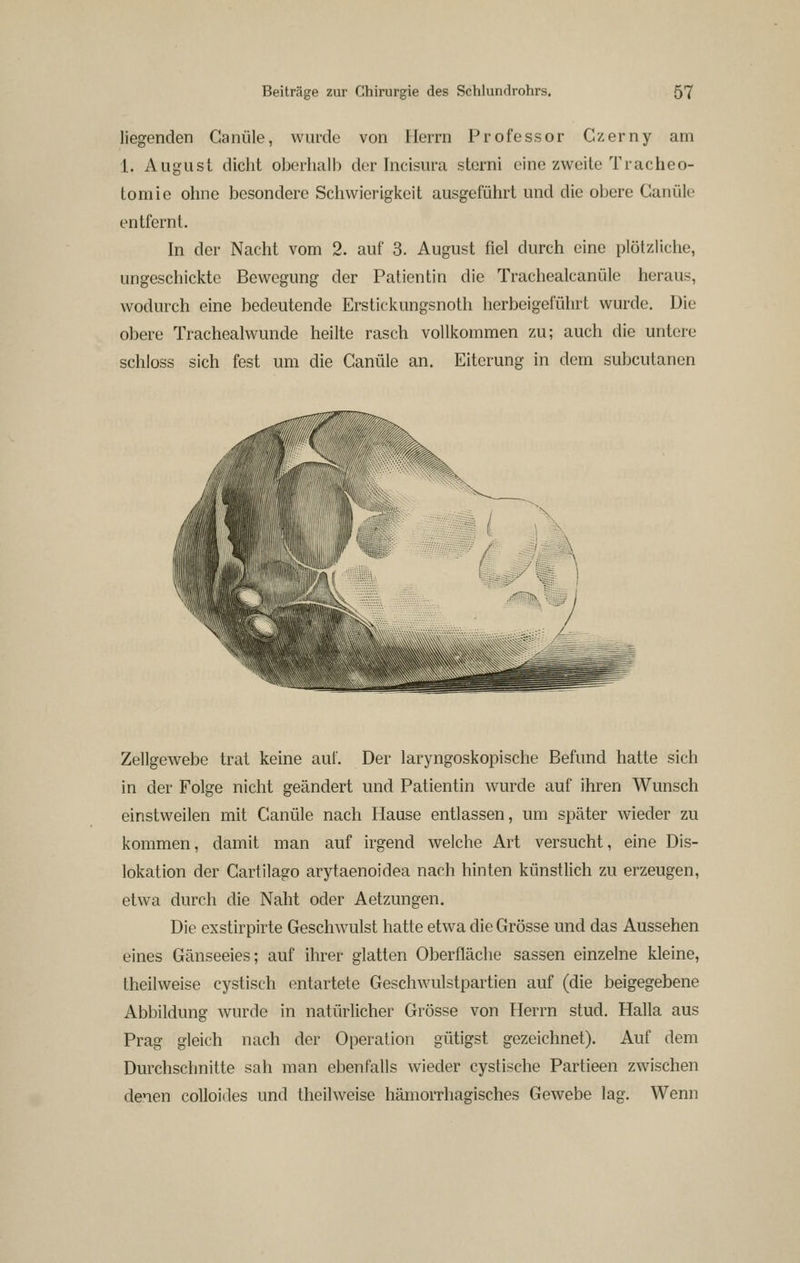 liegenden Canüle, wurde von Herrn Professor Czerny am 1. August dicht oberhalb der Incisura sterni eine zweite Tracheo- tomie ohne besondere Schwierigkeit ausgeführt und die obere Canüle entfernt. In der Nacht vom 2. auf 3. August fiel durch eine plötzliche, ungeschickte Bewegung der Patientin die Trachealcanüle heraus, wodurch eine bedeutende Erstickungsnoth herbeigeführt wurde. Die obere Trachealwunde heilte rasch vollkommen zu; auch die untere schloss sich fest um die Canüle an. Eiterung in dem subcutanen Zellgewebe trat keine auf. Der laryngoskopische Befund hatte sich in der Folge nicht geändert und Patientin wurde auf ihren Wunsch einstweilen mit Canüle nach Hause entlassen, um später wieder zu kommen, damit man auf irgend welche Art versucht, eine Dis- lokation der Gartilago arytaenoidea nach hinten künstlich zu erzeugen, etwa durch die Naht oder Aetzungen. Die exstirpirte Geschwulst hatte etwa die Grösse und das Aussehen eines Gänseeies; auf ihrer glatten Oberfläche sassen einzelne kleine, Iheilweise cystisch entartete Geschwulstpartien auf (die beigegebene Abbildung wurde in natürlicher Grösse von Herrn stud. Halla aus Prag gleich nach der Operation gütigst gezeichnet). Auf dem Durchschnitte sah man ebenfalls wieder cystische Partieen zwischen denen coUoides und theilweise hämorrhagisches Gewebe lag. Wenn