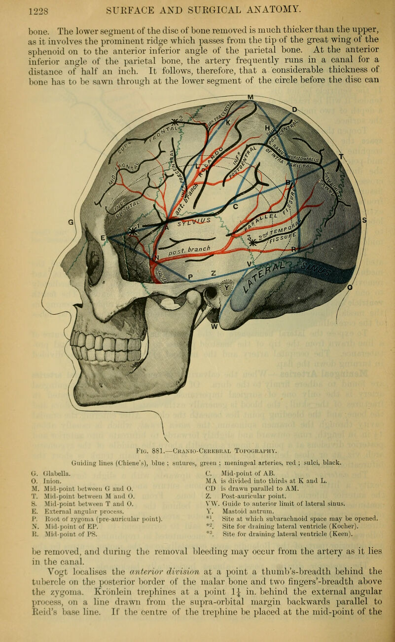 bone. The lower segment of the disc of bone removed is much thicker than the upper, as it involves the prominent ridge which passes from the tip of the great wing of the sphenoid on to the anterior inferior angle of the parietal bone. At the anterior inferior angle of the parietal bone, the artery frequently runs in a canal for a distance of half an inch. It follows, therefore, that a considerable thickness of bone has to be sawn through at the lower segment of the circle before the disc can Guiding lines (Cliiene G. Glabella. 0. Inion. M. Mid-point biitween G and 0. T. Mid-point between M and O. H. Mid-point between T and 0. E. External anguliir jiroce.s.s. P. Root of zygoma (pre-aurieular point). N. Mid-point of EP. R. Mid-point of PS. ChaiMO-Ckuebual Topography. hie ; sutures, green ; meningeal arteries, red ; sulci, black. C. Mid-point of AB, MA is divided into thirds at K and L. CD is drawn parallel to AM. Z. Post-auricular point. V\V. Guide to anterior limit of lateral sinus. V. Mastoid antrum. *'. Site at which subarachnoid space may be opened. *-. Site for draining lateral ventricle (Kocher). *•'. Site for draining lateral ventricle (Keen). be removed, and during the removal l)leeding may occur from the artery as it lies in the canal. Vogt localises the anterior division at a point a thumb's-breadth behind the tubercle on the posterior border of the malar bone and two fingers'-breadth above the zygoma. Kronlein trephines at a point 1^ in. behind the external angular process, on a line drawn from the supra-orbital margin backwards parallel to Reid's base line. If the centre of the trephine be placed at tlie mid-point of the