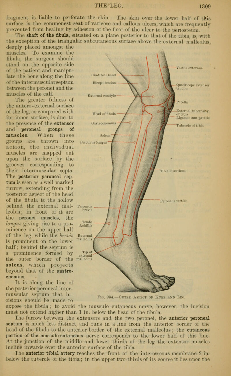 Ilio-tibial band Biceps tendon External condyle Vastus externus Quadriceps extensor u-ndon atella J-^xlernal tuberosity of tibia I.igamentum patellip Tubercle of tibia Tibialis anticus fragment is liable to perforate the skin. The skin over the lower half of this surface is the commonest seat of varicose and callous ulcers, which are frequently prevented from healing by adhesion of the tloor of the ulcer to the periosteum. The shaft of the fibula, situated on a plane posterior to that of the tibia, is, with the exception of the triangular subcutaneous surface above the external malleolus, deeply placed amongst the muscles. To examine the fibula, the surgeon should stand on the opposite side of the patient and manipu- late the bone along the line of the intermuscular septum between the peronei and the muscles of the calf. The greater fulness of the antero-external surface of the leg, as compared with its inner surface, is due to the presence of the extensor and peroneal groups of muscles. When these groups are thrown into action, the individual muscles are mapped out upon the surface by the grooves corresponding to their intermuscular septa. The posterior peroneal sep- tum is seen as a well-marked furrow, extending from the posterior aspect of the head of the fibula to the hollow behind the external mal- leolus ; in front of it are the peronei muscles, the long us giving rise to a pro- minence on the upper half of the leg, while the Irevis is prominent on the lower half: behind the septum is a prominence formed by the outer border of the soleus, which projects beyond that of the gastro- cnemius. It is along the line of the posterior peroneal inter- muscular septum that in- cisions should be made to expose the fibula; to avoid the musculo-cutaneous nerve, however, the incision must not extend higher than 1 in. below the head of the fibula. The furrow between the extensors and the two peronei, the anterior peroneal septum, is much less distinct, and runs in a line from the anterior border uf the head of the fibula to the anterior border of the external malleolus : the cutaneous portion of the musculo-cutaneous nerve corresponds to the lower half of this line. At the junction of the middle and lower thirds of the leg the extensor muscles incline inwards over the anterior surface of the tibia. The anterior tibial artery reaches the front of the interosseous membrane 2 in. below the tubercle of the tibia ; in the upper two-thirds of its course it lies upon the Peroueus tertius Fig. yo4.—Outer Aspect of Knee and Lei;