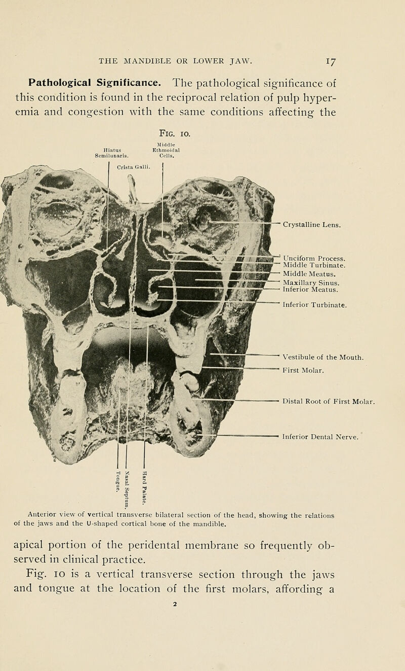 Pathological Significance. The pathological significance of this condition is found in the reciprocal relation of pulp hyper- emia and congestion with the same conditions affecting the Fig. 10. Crystalline Lens. Unciform Process. Middle Turbinate. Middle Meatus. Maxillary Sinus. Inferior Meatus. Inferior Turbinate. Vestibule of the Mouth. First Molar. Distal Root of First Molar. Inferior Dental Nerve. Anterior view of vertical transverse bilateral section of the head, shov^^ing the relations of the jaws and the U-shaped cortical bone of the mandible. apical portion of the peridental membrane so frequently ob- served in clinical practice. Fig. 10 is a vertical transverse section through the jaws and tongue at the location of the first molars, affording a