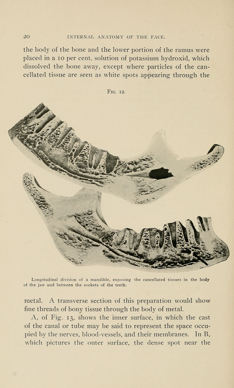 the body of the bone and the lower portion of the ramus were placed in a lo per cent, solution of potassium hydroxid, which dissolved the bone away, except where particles of the can- cellated tissue are seen as white spots appearing through the Fig. 12. Longitudinal division of a mandible, exposing the cancellated tissues in the body of the jaw and between the sockets of the teeth. metal. A transverse section of this preparation would show fine threads of bony tissue through the body of metal. A, of Fig. 13, shows the inner surface, in which the cast of the canal or tube may be said to represent the space occu- pied by the nerves, blood-vessels, and their membranes. In B, which pictures the outer surface, the dense spot near the