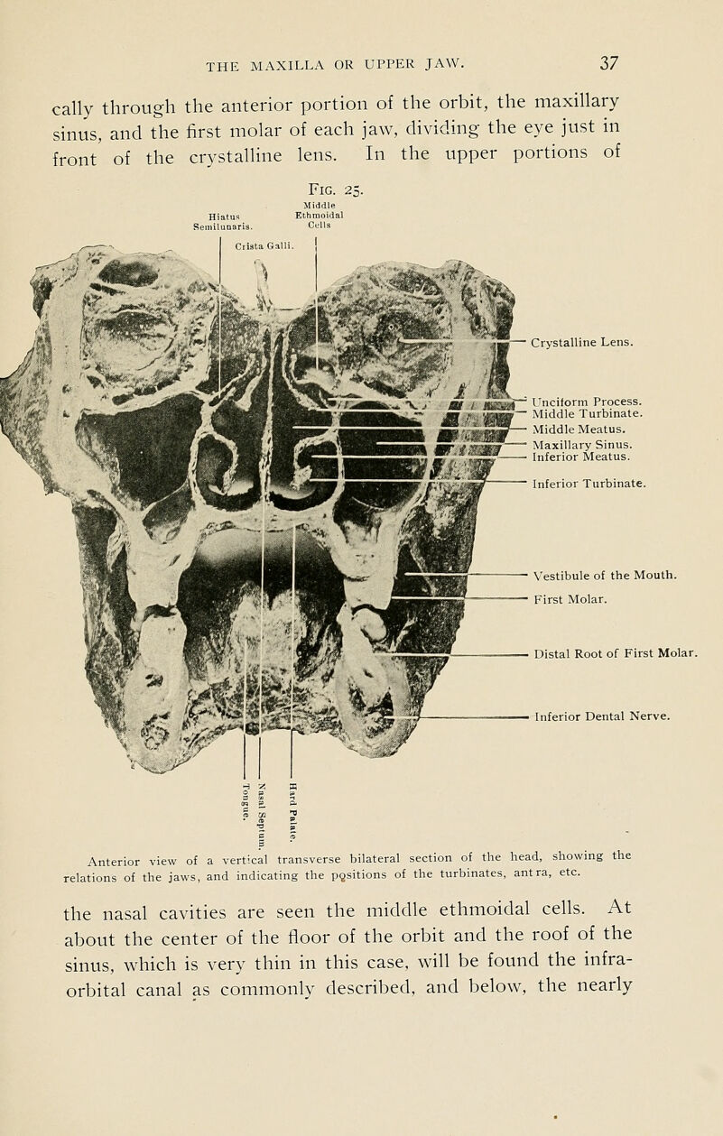 cally through the anterior portion of the orbit, the maxillary sinus, and the first molar of each jaw, dividing the eye just in front of the crystalline lens. In the upper portions of Fig. 25. Crystalline Lens. / 1 V J mi ^^iT^ Unciform Process. / • 'd^BS~ Middle Turbinate. Middle Meatus. Maxillary Sinus. Inferior Meatus. Inferior Turbinate. Vestibule of the Mouth. First Molar. Distal Root of First Molar. Inferior Dental Nerve. Anterior view of a vertical transverse bilateral section of the head, showing the relations of the jaws, and indicating the pcjsitions of the turbinates, antra, etc. the nasal cavities are seen the middle ethmoidal cells. At about the center of the floor of the orbit and the roof of the sinus, which is very thin in this case, will be found the infra- orbital canal as commonly described, and below, the nearly