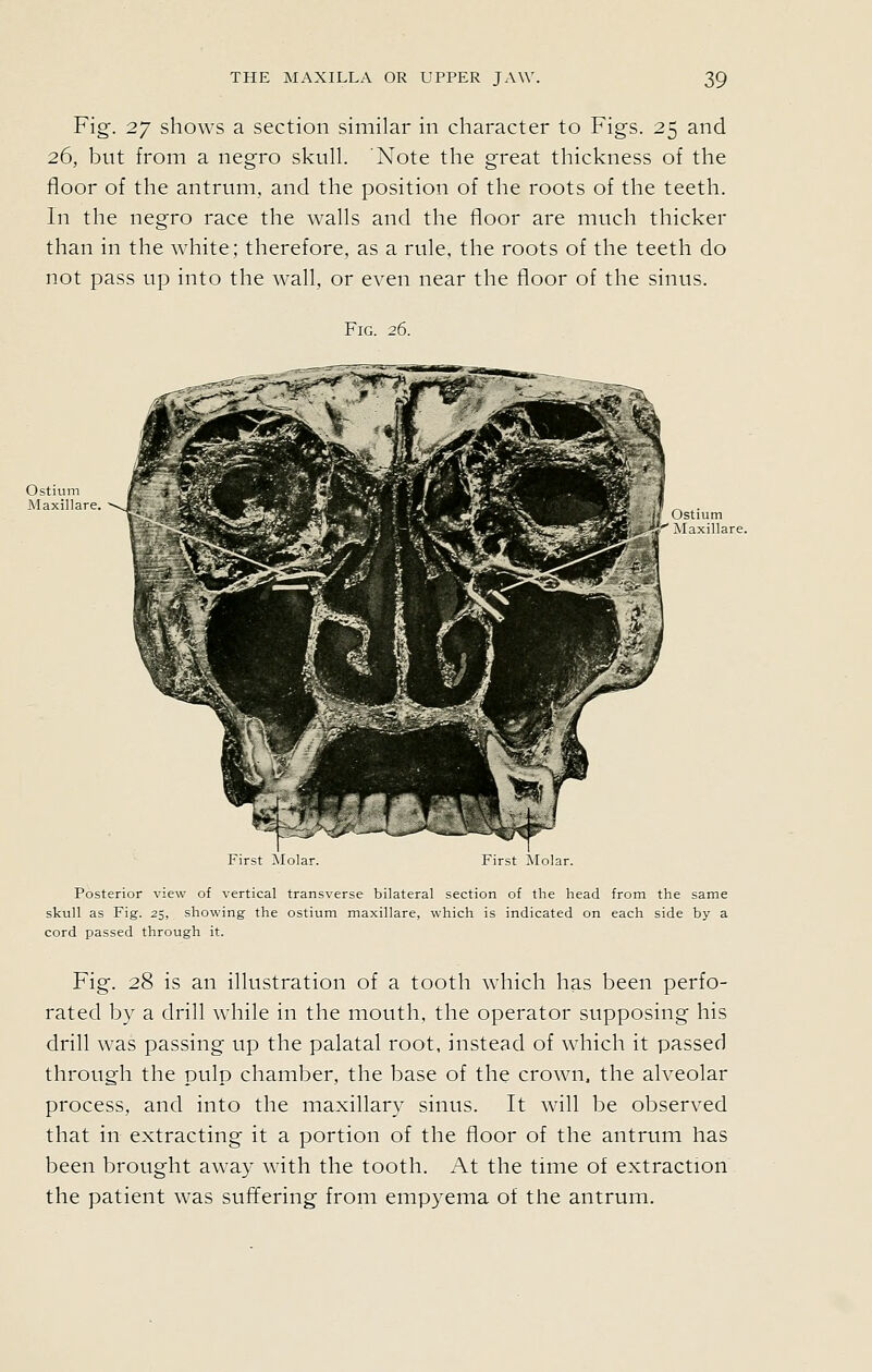 Fig-. 27 shows a section similar in character to Figs. 25 and 26, but from a negro skull. Note the great thickness of the floor of the antrum, and the position of the roots of the teeth. In the negro race the walls and the floor are much thicker than in the white; therefore, as a rule, the roots of the teeth do not pass up into the wall, or even near the floor of the sinus. Fig. 26. First Molar First Molar. Posterior view of vertical transverse bilateral section of the head from the same skull as Fig. 25, shoviJing the ostium maxillare, which is indicated on each side by a cord passed through it. Fig. 28 is an illustration of a tooth which has been perfo- rated by a drill wdiile in the mouth, the operator supposing his drill was passing up the palatal root, instead of which it passed through the pulp chamber, the base of the crown, the alveolar process, and into the maxillary sinus. It will be observed that in extracting it a portion of the floor of the antrum has been brought away with the tooth. At the time of extraction the patient was suffering from empyema of the antrum.