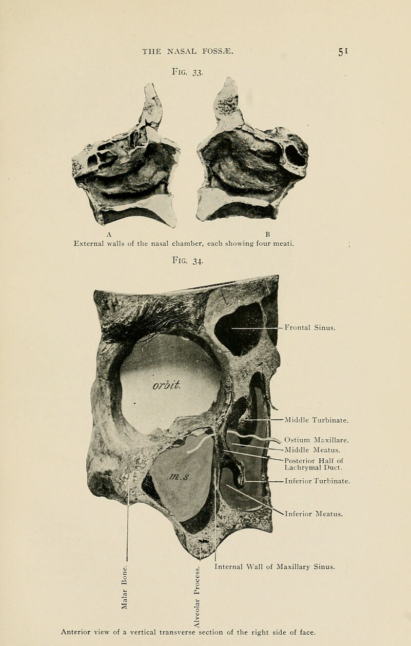 Fig. 3.3. A B External walls of the nasal chamber, each showing four meati. Fig. 34. — Frontal Sinus. Middle Turbinate. Ostium Maxillare. Middle Meatus. Posterior Half of Lachrymal Duct. Inferior Turbinate. Inferior Meatus. Internal Wall of Maxillary Sinus. Anterior view of a vertical transverse section of the right side of face.