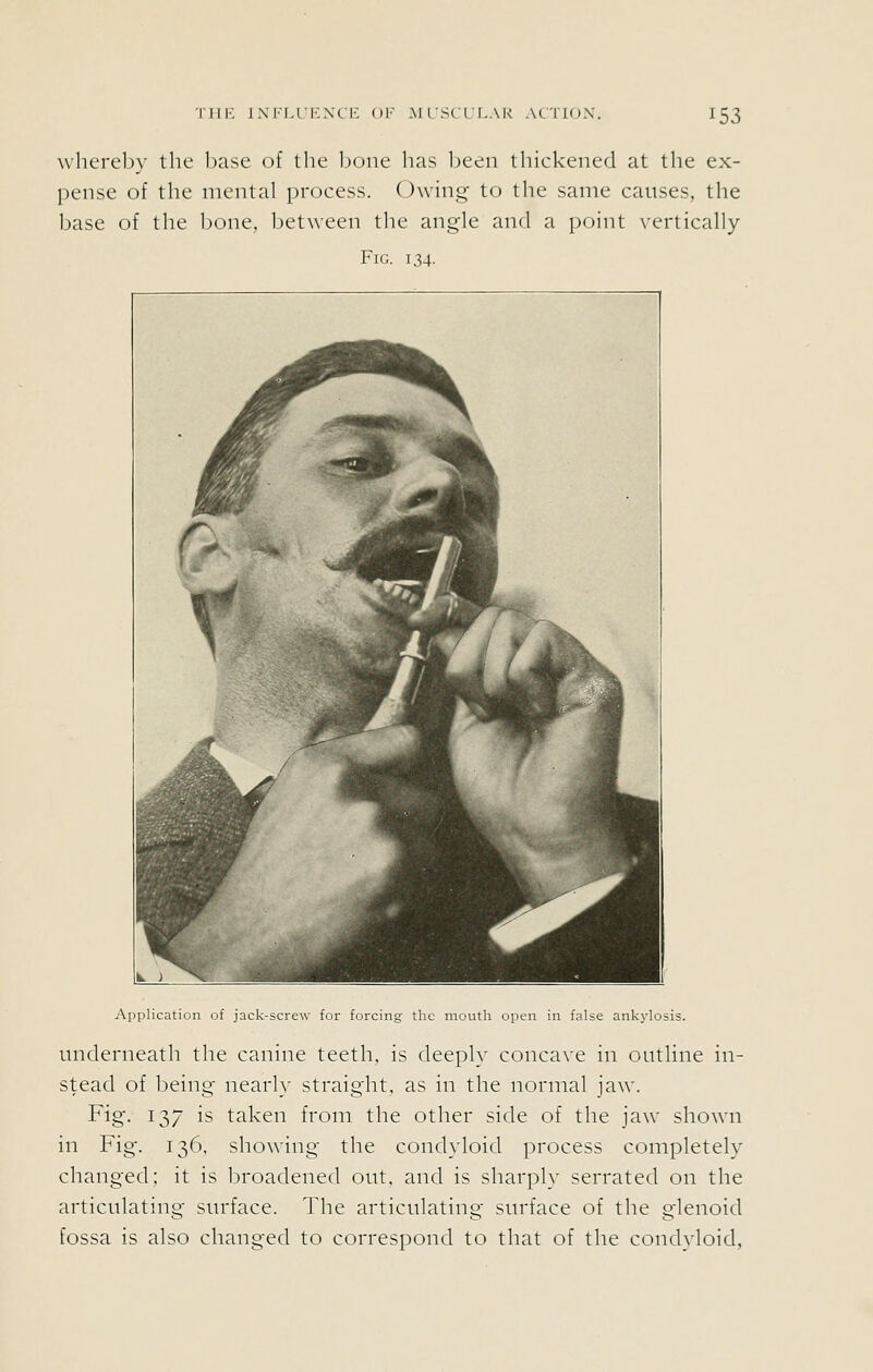 \vhereb}' tlie base of tlie Ijone has Ijeeii Ihickened at the ex- pense of the mental process. Owing to the same causes, the base of the Ijone, l)et\veen the angle and a point vertically Fig. 134. Application of jack-screw for forcing the mouth open in false ankylosis. underneath the canine teeth, is deeply concave in outline in- stead of being- nearly straight, as in the normal ja^^■. Fig. 137 is taken from the other side of the jaw shown in Fig. 136, showing the condyloid process completely changed; it is broadened out, and is sharply serrated on the articulating surface. The articulating surface of the glenoid fossa is also changed to correspond to that of the condvloid,