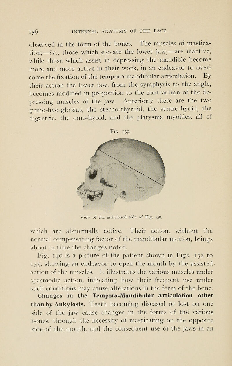 observed in the form of the bones. The muscles of mastica- tion,—i.e., those which elevate the lower jaw,—are inactive, while those which assist in depressing the mandible become more and more active in their work, in an endeavor to over- come the fixation of the temporo-mandibular articulation. By their action the lower jaw, from the symphysis to the angle, becomes modified in proportion to the contraction of the de- pressing muscles of the jaw. Anteriorly there are the two genio-hyo-glossus, the sterno-thyroid, the sterno-hyoid, the digastric, the omo-hyoid, and the platysma myoides, all of Fig. 139. View of the ankylosed side of Fig. 138. which are abnormally active. Their action, without the normal compensating factor of the mandibular motion, brings about in time the changes noted. Fig. 140 is a picture of the patient shown in Figs. 132 to 135, showing an endeavor to open the mouth by the assisted- action of the muscles. It illustrates the various muscles under spasmodic action, indicating how their frequent use under such conditions may cause alterations in the form of the bone. Changes in the Temporo=MandibuIar Articulation other than by Ankylosis. Teeth becoming diseased or lost on one side of the jaw cause changes in the forms of the various bones, through the necessity of masticating on the opposite side of the mouth, and the consecjuent use of the jaws in an