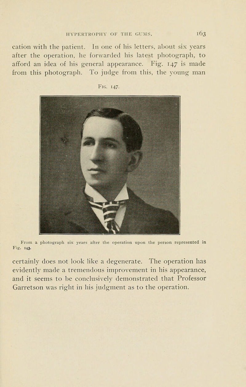 cation witli the patient. In one of liis letters, aljout six years after tlie operation, he forwarded his latest ])hotograph, to afford an idea of his g-eneral a])pearance. Fig. 147 is made from this photograph. To jndge from this, the young man Fig. 147. From a photograph six years after the operation upon the person represented in Fig. 143- certainly does not look like a degenerate. The operation has evidently made a tremendous improvement in his appearance, and it seems to be conclusively demonstrated that Professor Garretson was right in his judgment as to the operation.