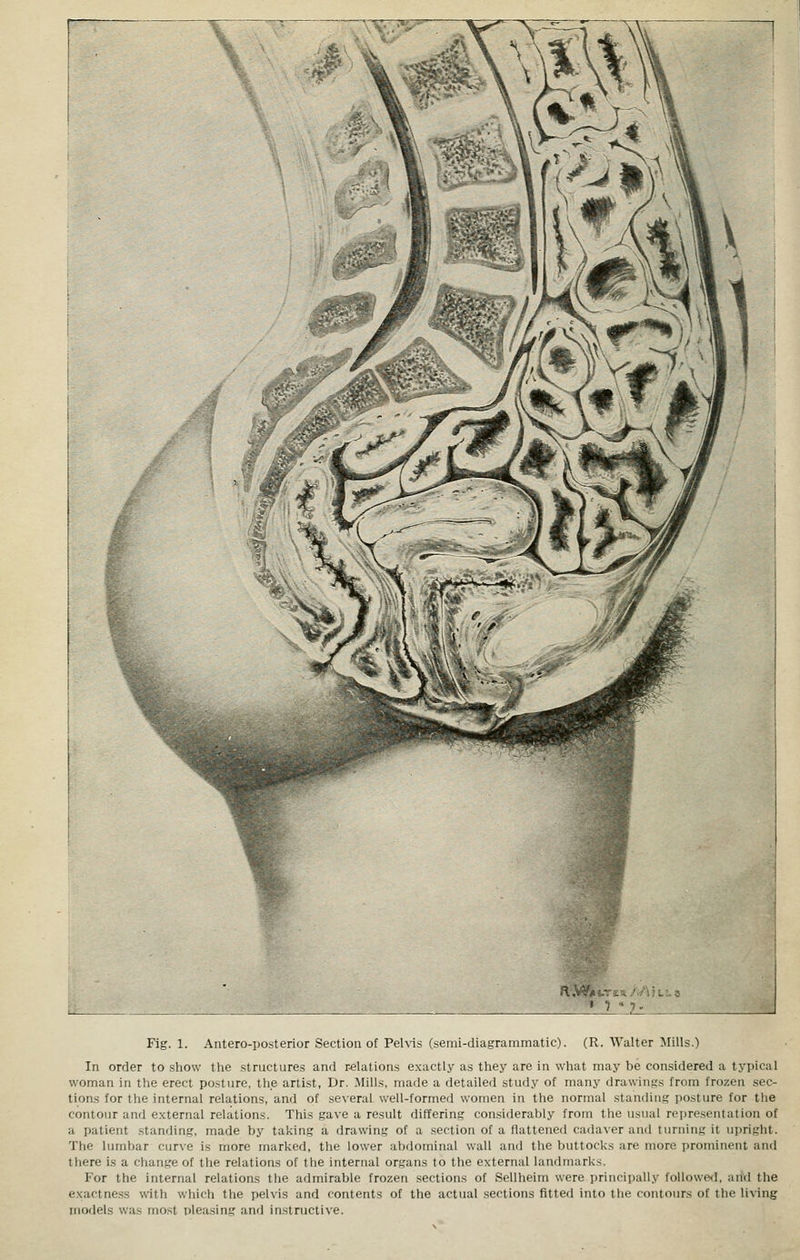 Fig. 1. Antero-posterior Section of Pelvis (semi-diagrammatic). (R. Walter Mills.) In order to .show the structures and relations exactly as they are in what may be considered a typical woman in the erect posture, the artist, Dr. Mills, made a detailed study of many drawings from frozen sec- tions for the internal relations, and of several well-formed women in the normal standing posture for the contour anrl external relations. This gave a result differing considerably from the usual representation of a patient standing, made by taking a drawing of a section of a flattened cadaver and turning it upright. The lumbar curve is more marked, the lower abdominal wall and the buttocks are more prominent and there is a change of the relations of the internal organs to the external landmarks. For the internal relations the admirable frozen sections of Sellheim were principally followed, and the exactness with which the pelvis and contents of the actual sections fitted into the contours of the living models was most pleasing and instructive.