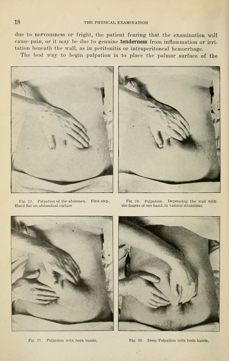 due to nervousness or fright, the patient fearing that the examination will cause pain, or it may be due to genuine tenderness from inflammation or irri- tation beneath the wall, as in peritonitis or intraperitoneal hemorrhage. The best way to begin palpation is to place the palmar surface of the Fig. 23. Palpation of the abdomen. First step. Hand flat on abdominal surface Fig. 24. Palpation. Depressing the wall with the fingers of one hand, in various situations. FIk. 2.'), Palpation witli both hands. Fig. 26. Dfej) Palpation witii i)otli lui'ndtj.