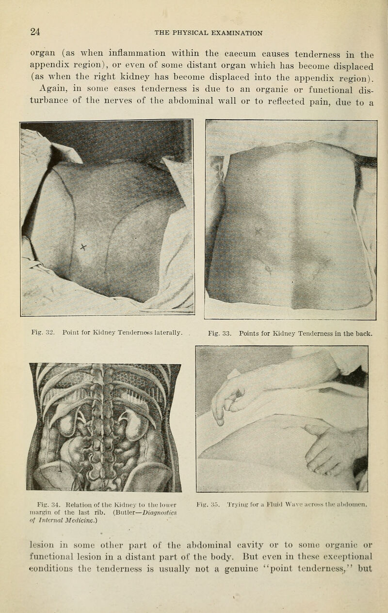 organ (as when inflammation within the caecum causes tenderness in the appendix region), or even of some distant organ which has become displaced (as when the right kidney has become displaced into the appendix region). Again, in some cases tenderness is due to an organic or functional dis- turbance of the nerves of the abdominal wall or to reflected pain, due to a Fig. 32. Point for Kidney Tenderness laterally. . Fig. 33. Points for Ividney Tenderness in the back. Fig. 34. Relation of the Ividney to the lower margin of the last rib. (Butler—Diagnostics of Internal Medicine.) TrN iiig lor ii ]''liiiil \\'a\ ^^ Mcross I ho iilidonu'ii. lesion in some other part of the abdominal cavity or to some organic or functional lesion in a distant part of the body. But even in these exceptional <ionditions the tenderness is usually not a genuine point tenderness, but