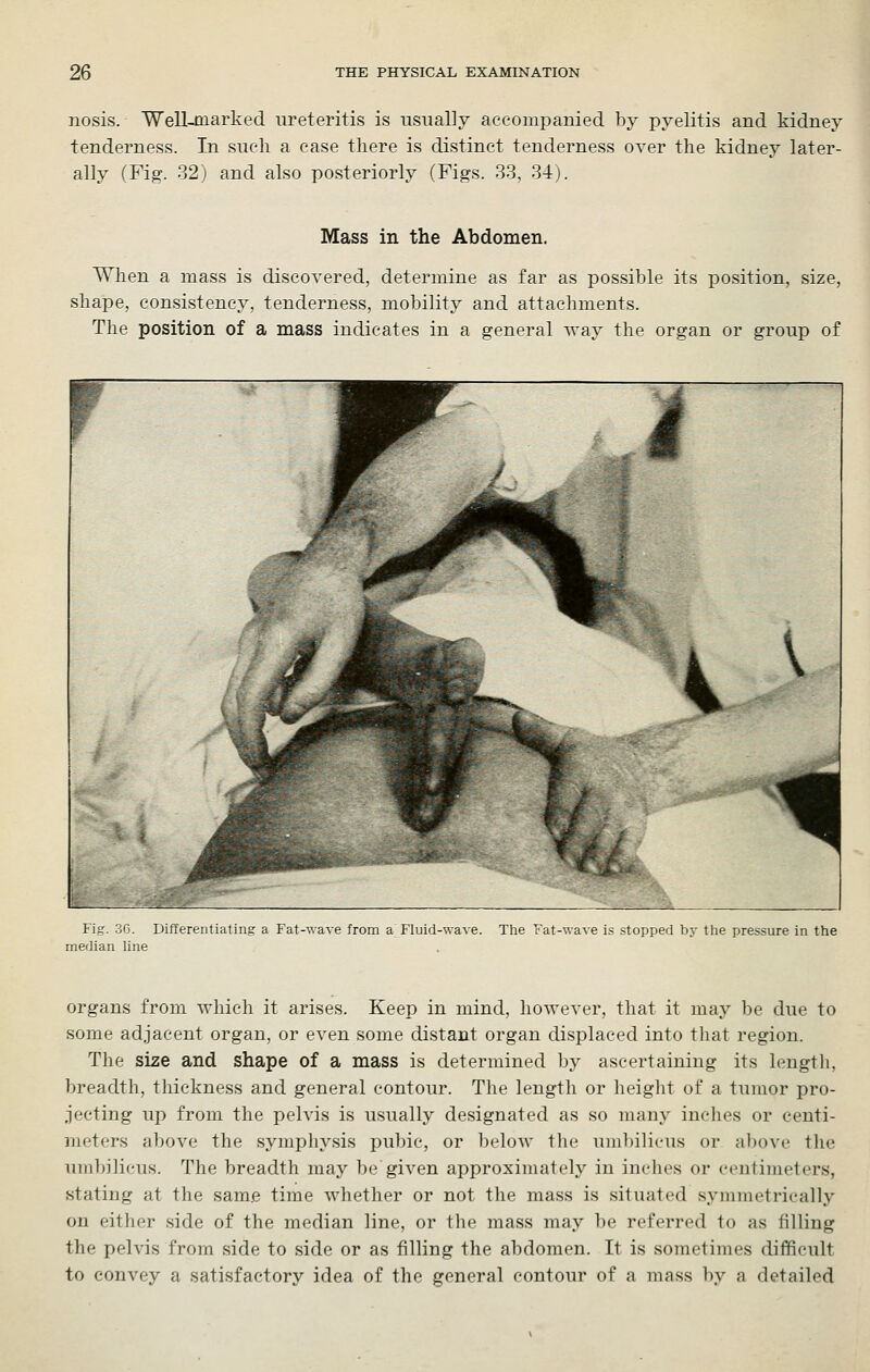 nosis. Well-marked ureteritis is usually accompanied by pyelitis and kidney tenderness. In such a case there is distinct tenderness over the kidney later- ally (Fig. 32) and also posteriorly (Figs. 33, 34). Mass in the Abdomen. When a mass is discovered, determine as far as possible its position, size, shape, consistency, tenderness, mobility and attachments. The position of a mass indicates in a general way the organ or group of Fig. oG. Differentiating a Fat-wave from a Fluid-wave. Tlie Fat-wave is stopped by tlie pressure in the median line organs from which it arises. Keep in mind, however, that it may be due to some adjacent organ, or even some distant organ displaced into that region. The size and shape of a mass is determined by ascertaining its length, breadth, thickness and general contour. The length or height of a tumor pro- jecting up from the pelvis is usually designated as so many inches or centi- meters above the symphysis pubic, or ])elow tbe uml)ilicus or aliove the lunbilicus. The breadth may be given approximately in inelies or centimeters, stating at the same time whether or not the mass is situated symmetrically on either side of the median line, or the mass may be referred to as filling the pelvis from side to side or as filling the abdomen. It is sometimes difficult to convey a satisfactory idea of the general contour of a mass by a detailed